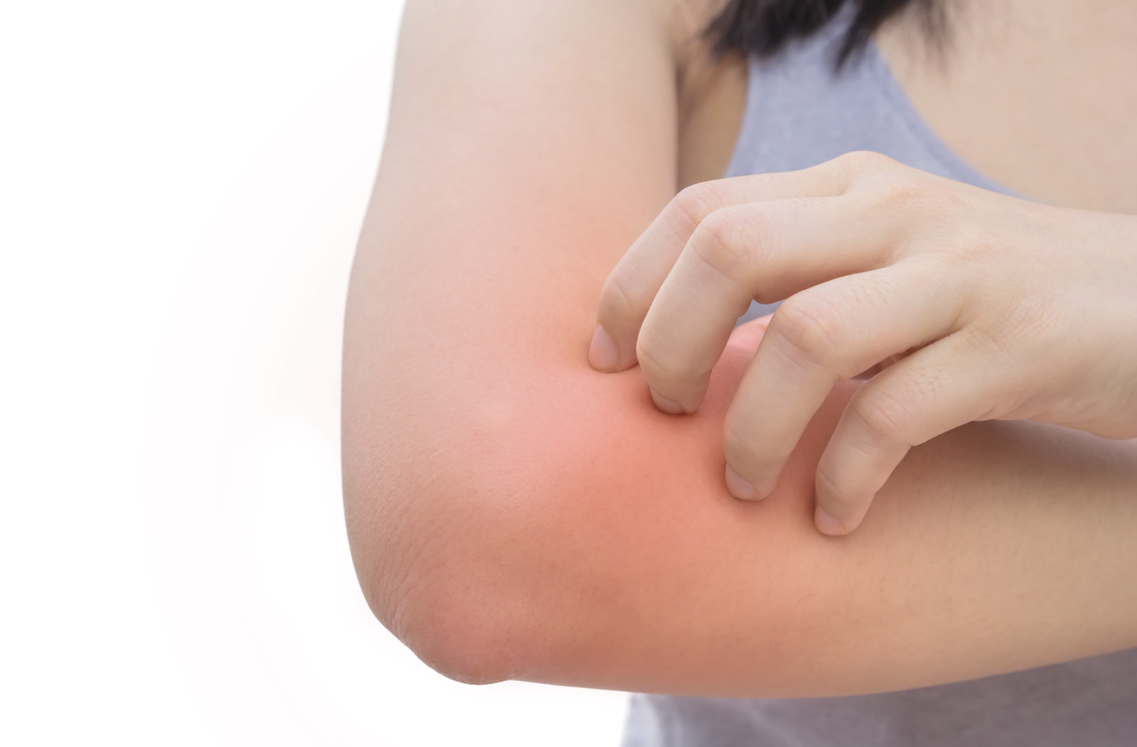 dermatology-surgery-associates-bronx-ny-candidiasis-1