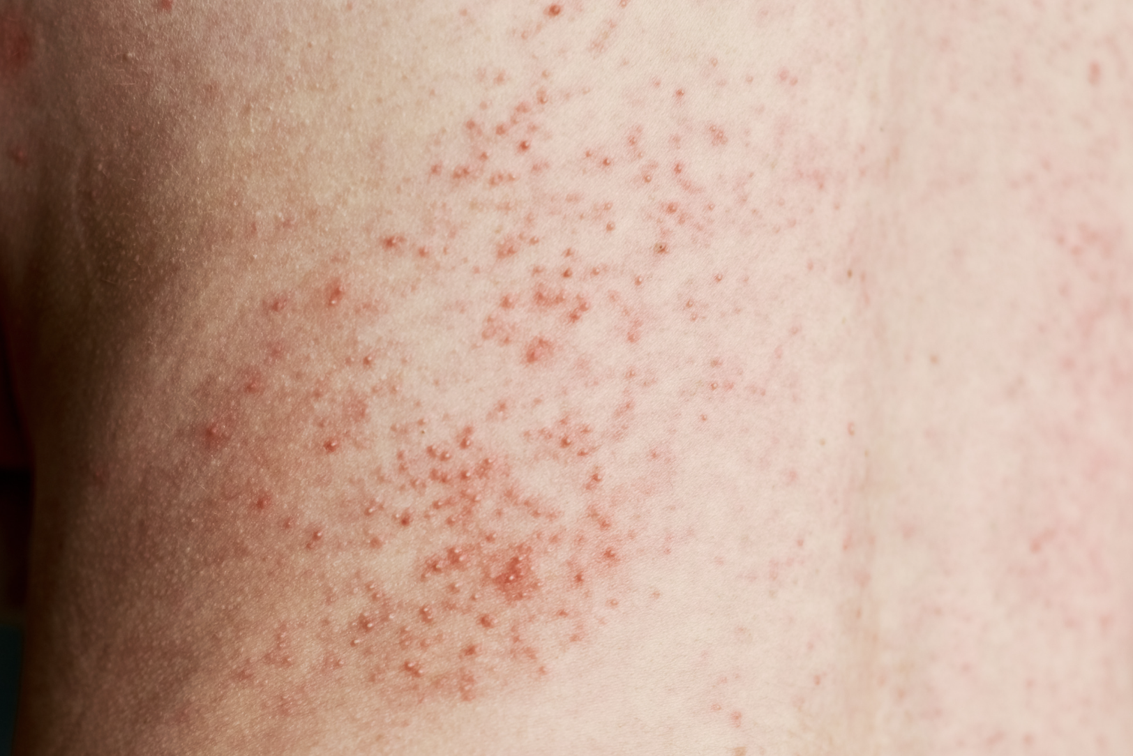 dermatology-surgery-associates-bronx-ny-candidiasis