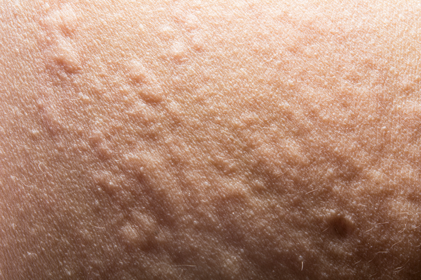 dermatology-surgery-associates-dsa-Hidradenitis- Suppurativa-1