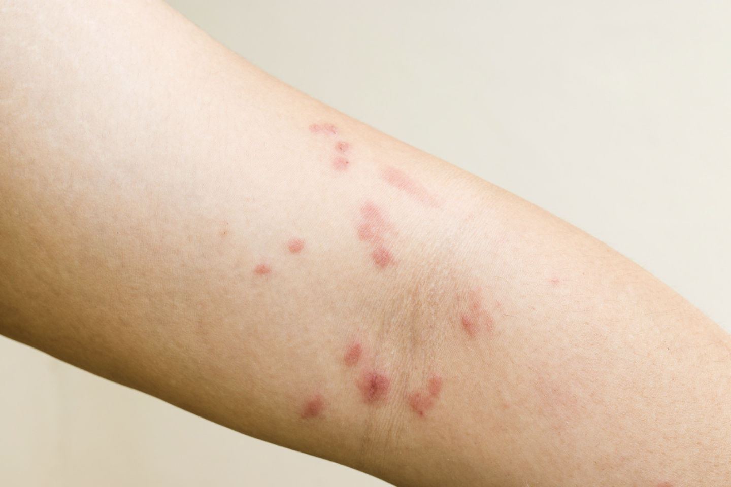 dermatology-surgery-associates-dsa-Hidradenitis- Suppurativa
