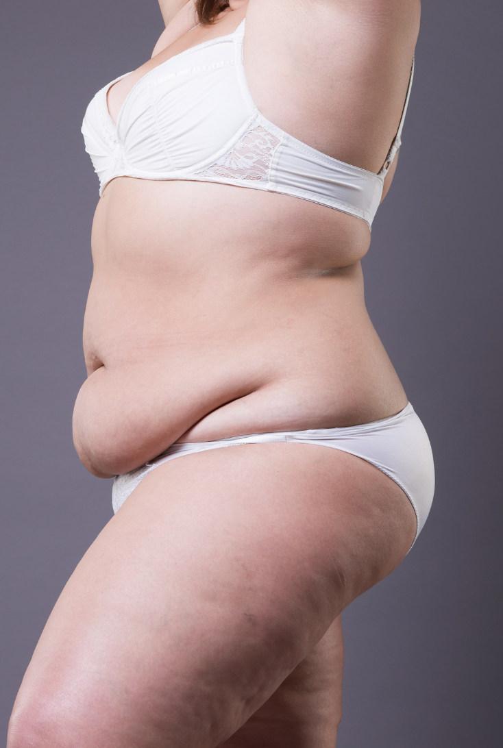 dermatology-surgery-associates-dsa-bronx-ny-abdominoplasty-tummy-tuck-1