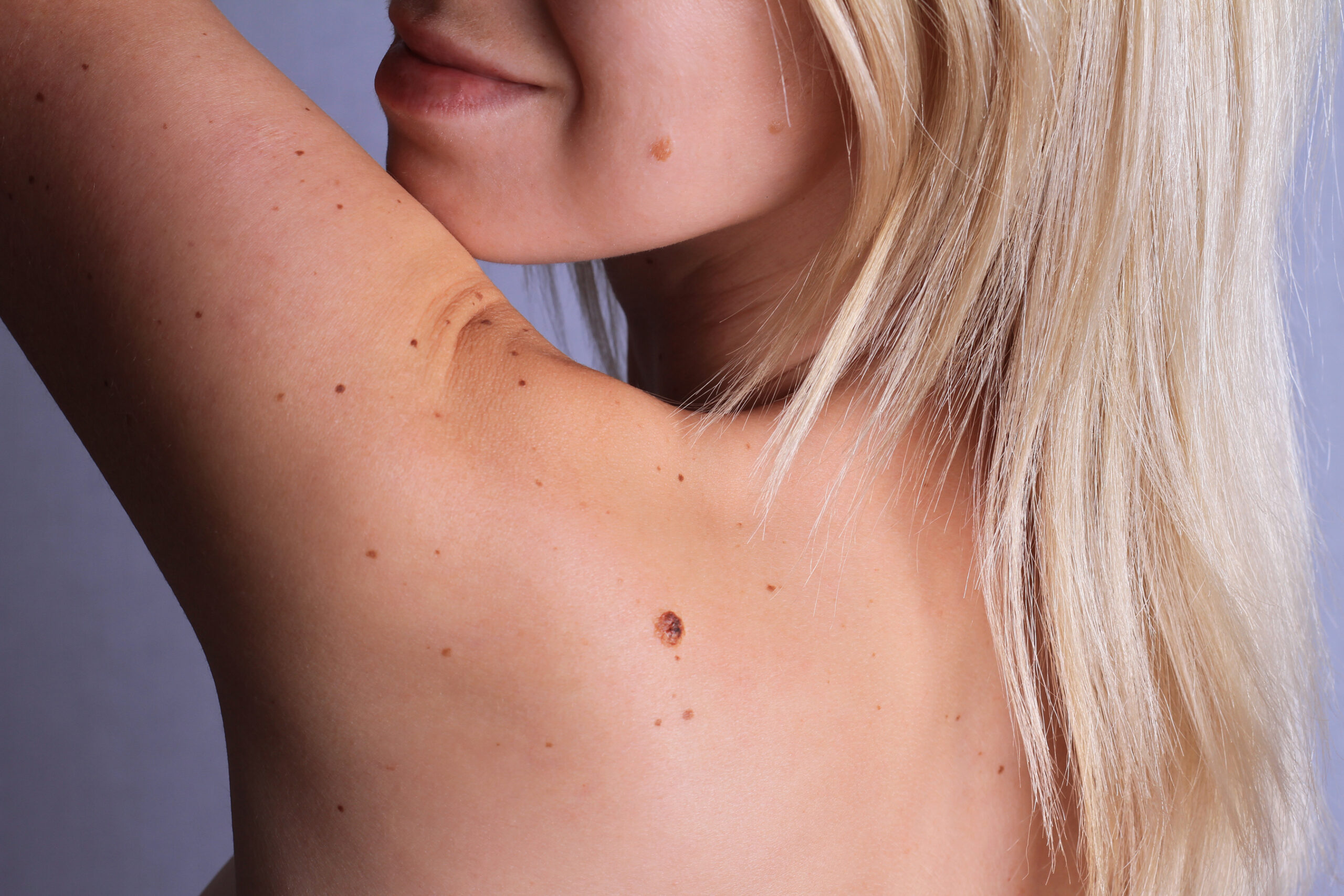 Woman with birthmarks on her back and face