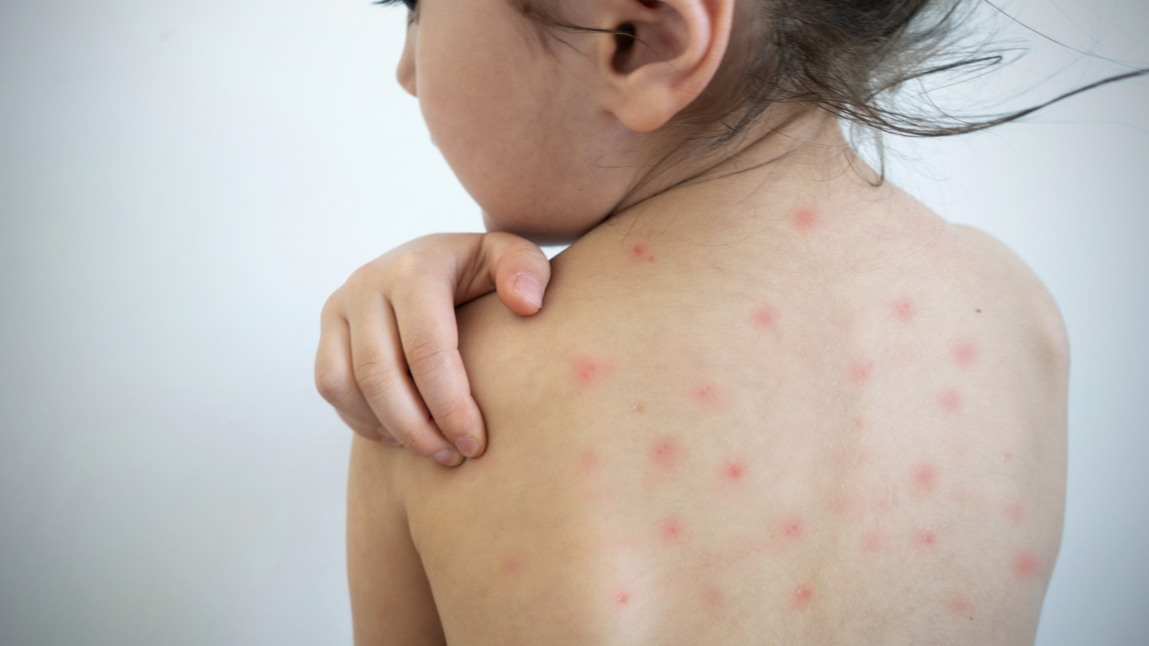 dermatology-surgery-associates-dsa-bronx-ny-chickenpox-1