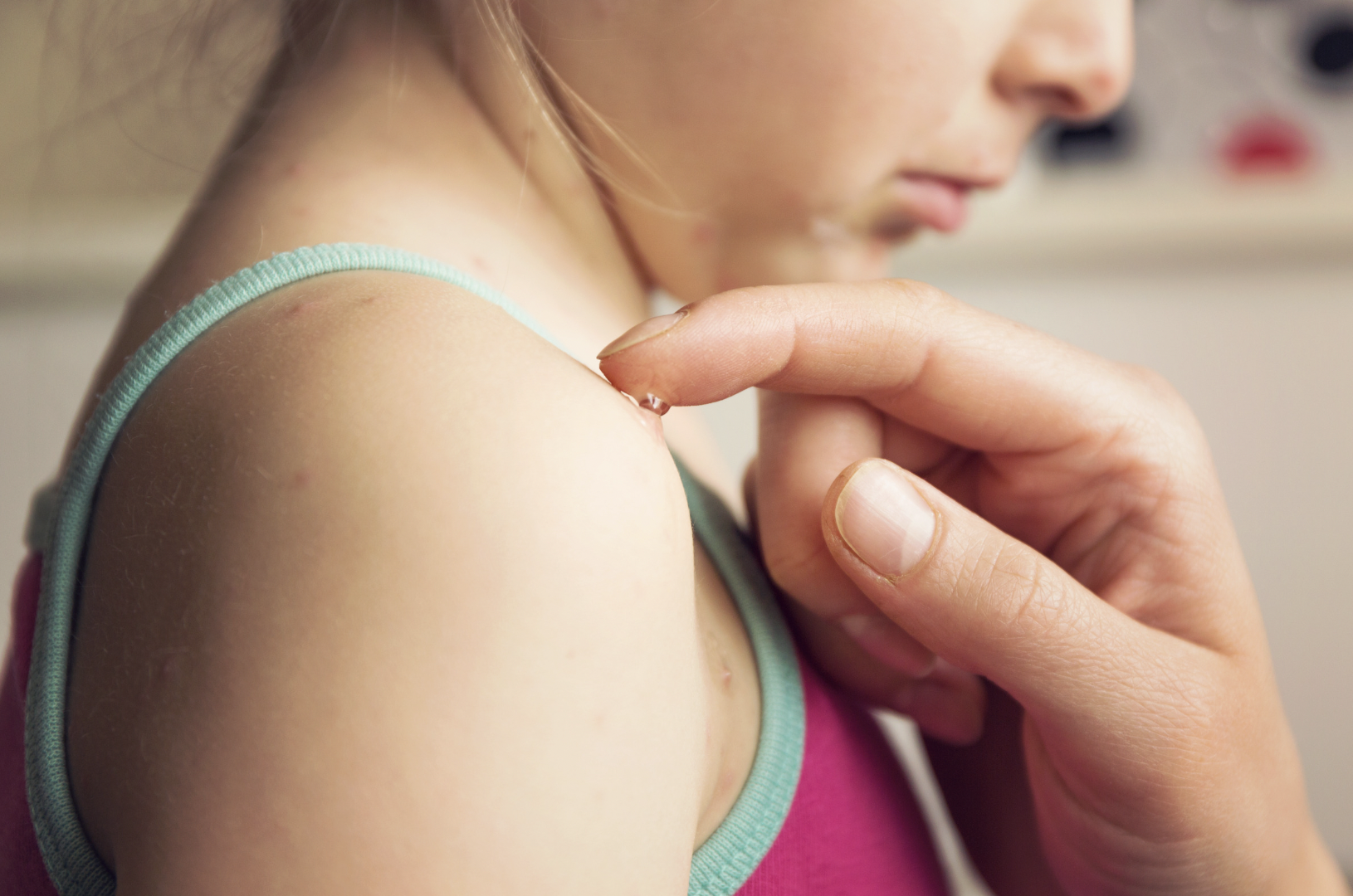 dermatology-surgery-associates-dsa-bronx-ny-chickenpox
