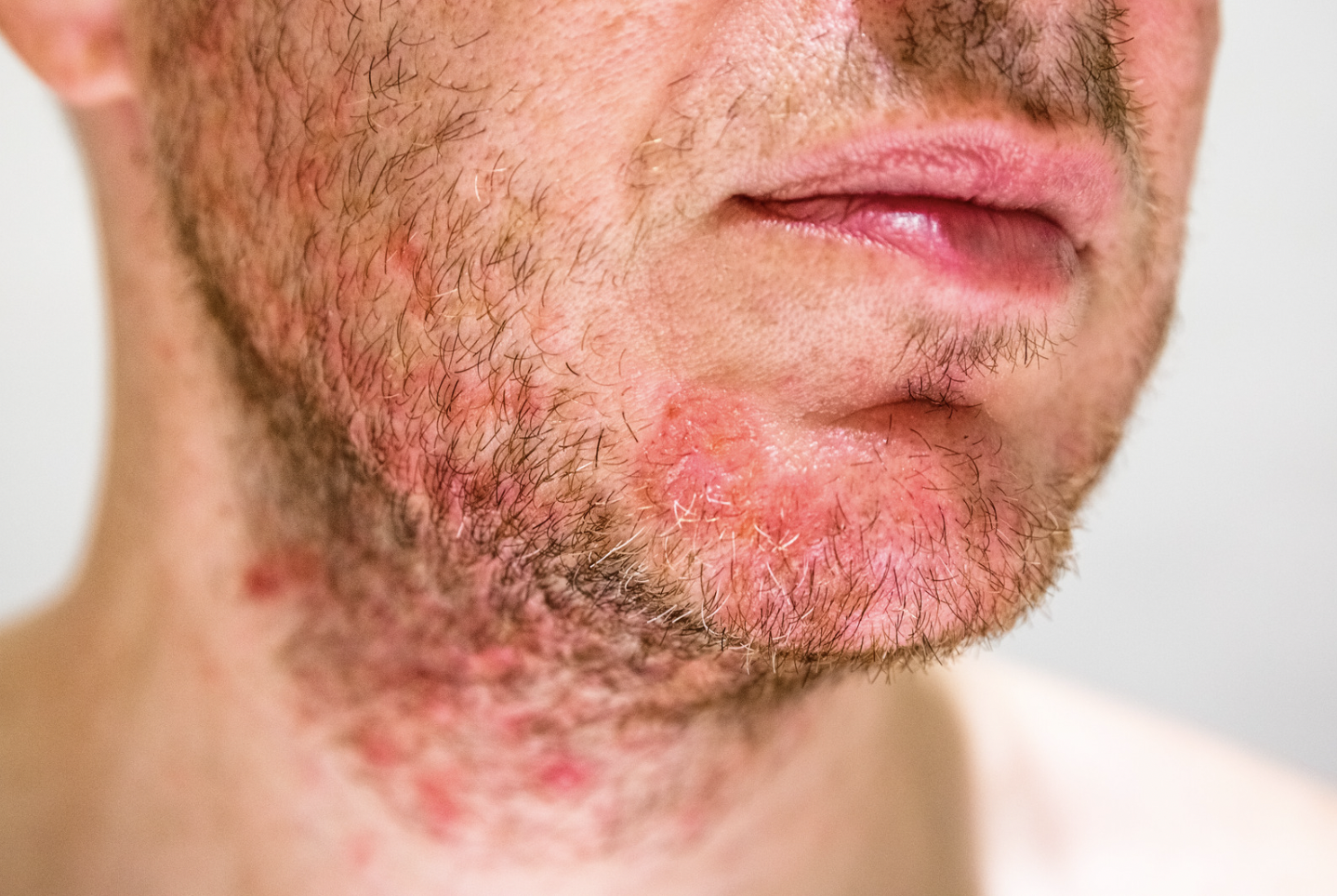 dermatology-surgery-associates-dsa-bronx-ny-folliculitis-1 dermatology surgery associates folliculitis on chin and neck bronx ny