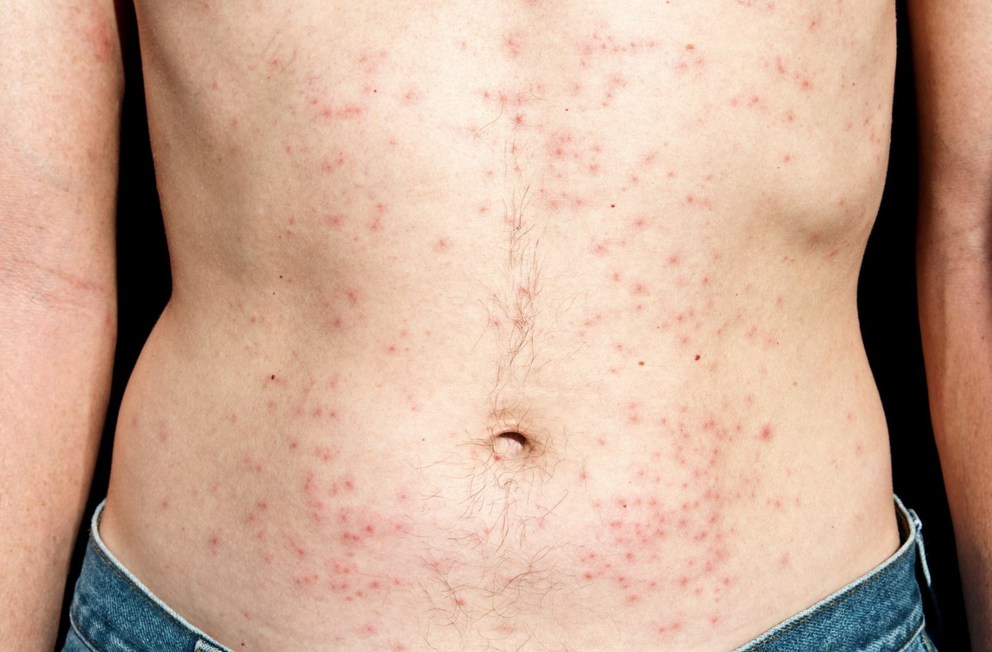 dermatology-surgery-associates-dsa-bronx-ny-folliculitis dermatology surgery associates folliculitis on stomach bronx ny