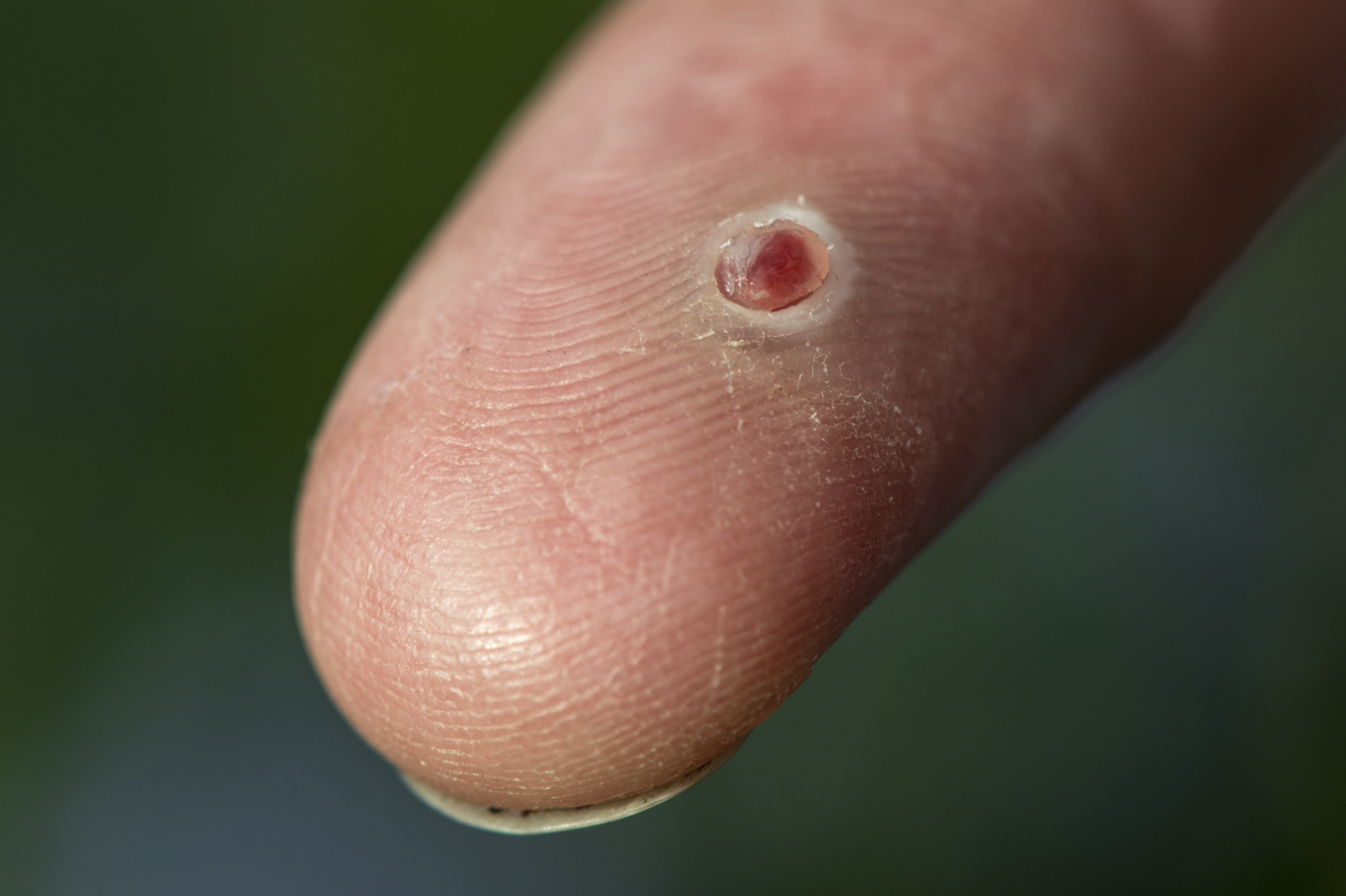 dermatology-surgery-associates-dsa-bronx-ny-granuloma-1
