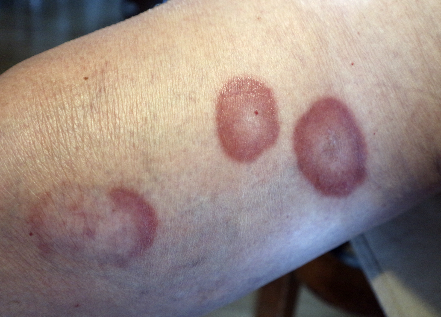 dermatology-surgery-associates-dsa-bronx-ny-granuloma