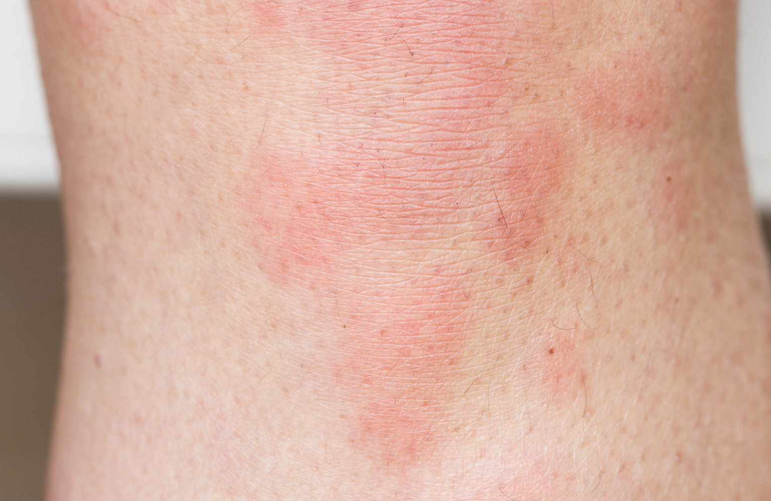 dermatology-surgery-associates-dsa-bronx-ny-hives-1