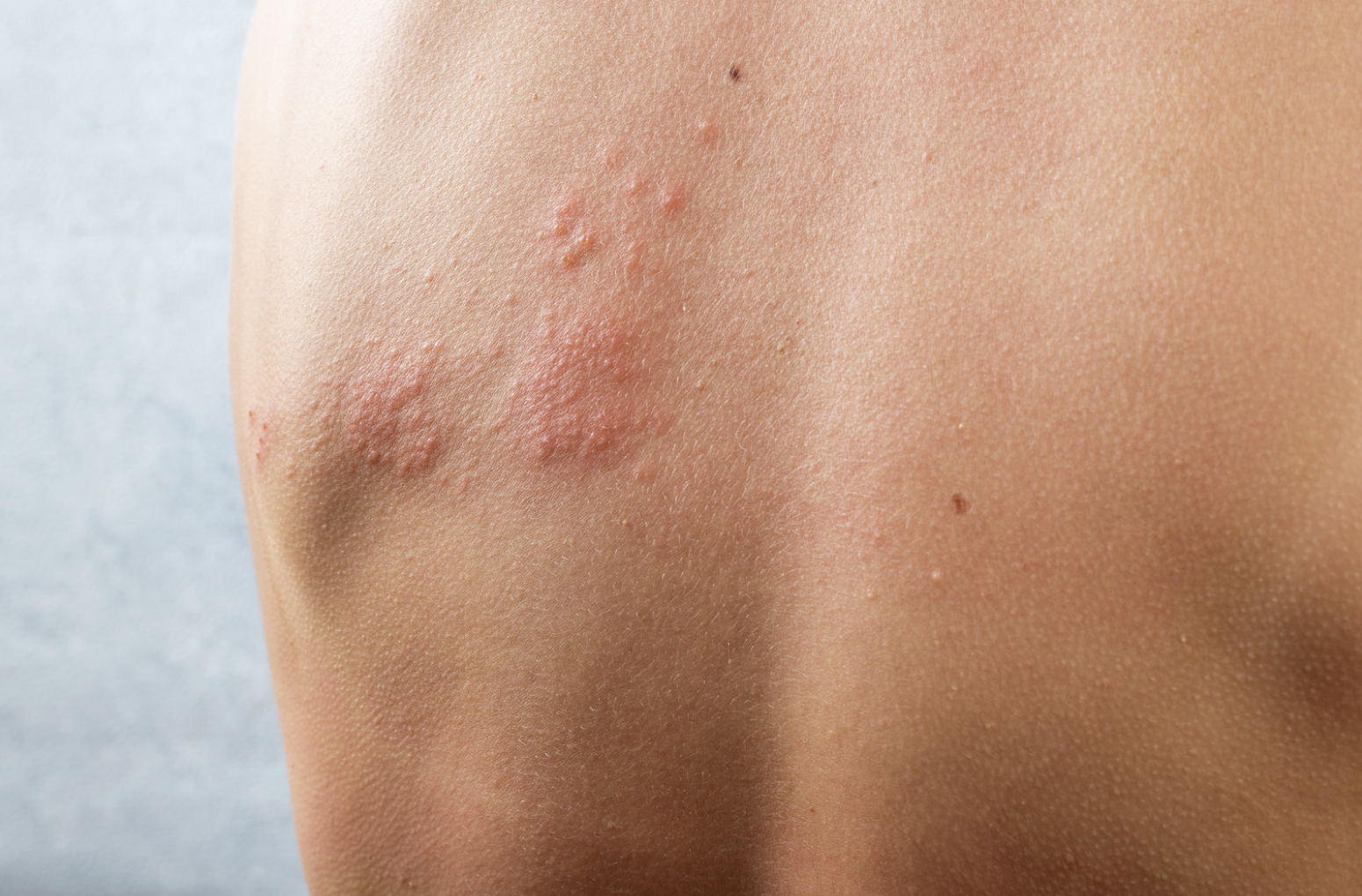 dermatology-surgery-associates-dsa-bronx-ny-hives