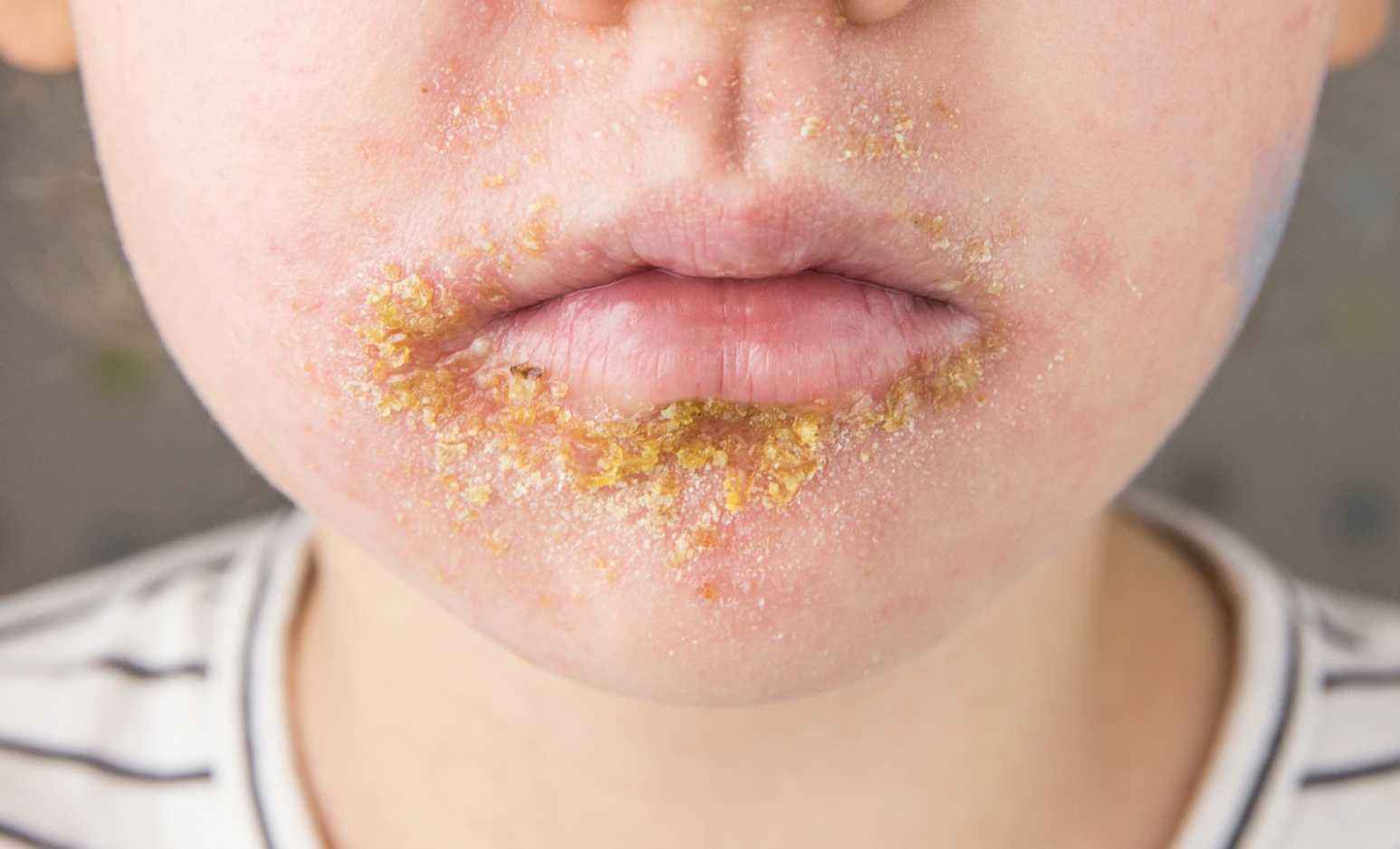 dermatology-surgery-associates-dsa-bronx-ny-impetigo-1