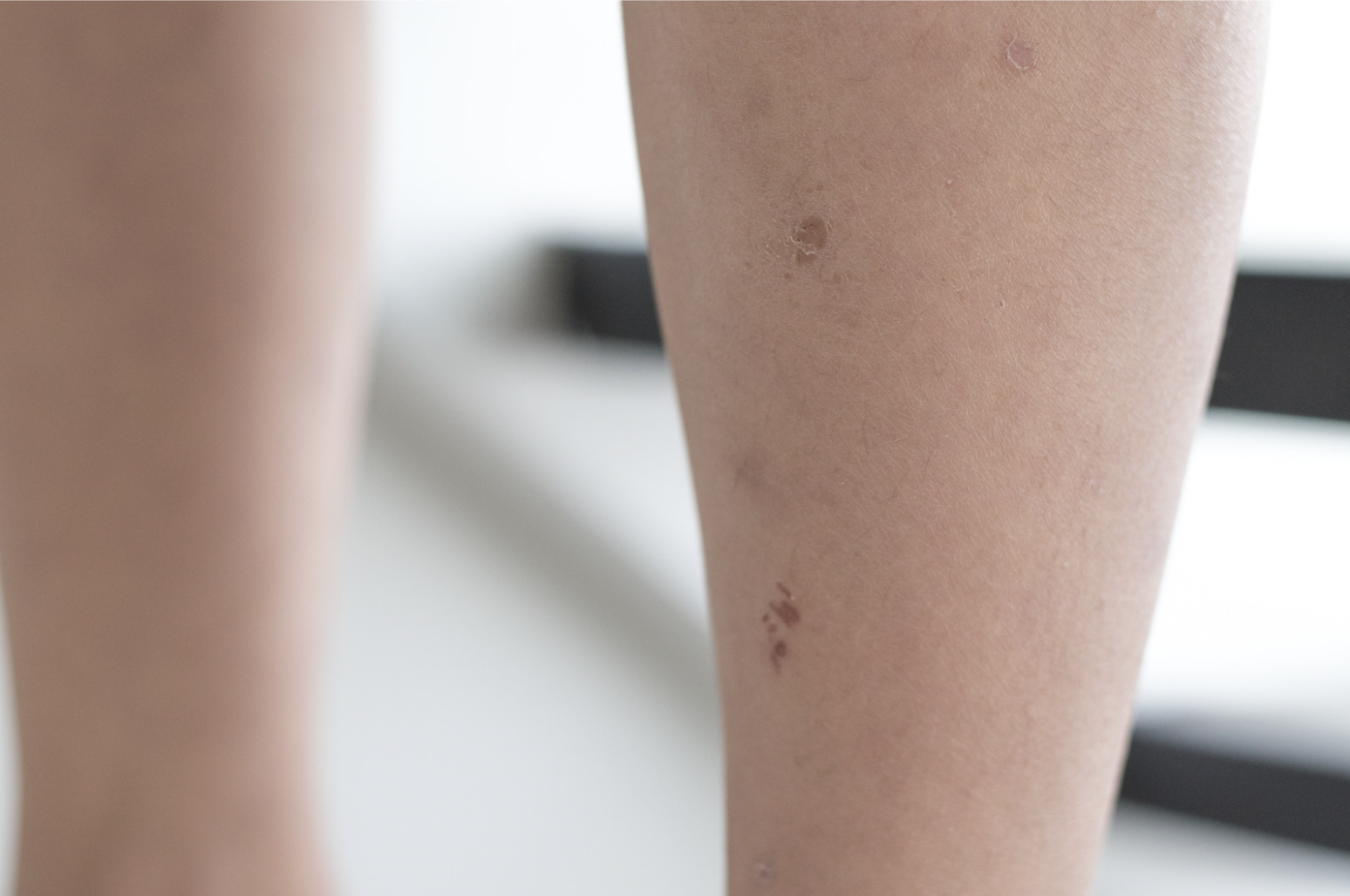 dermatology-surgery-associates-dsa-bronx-ny-impetigo