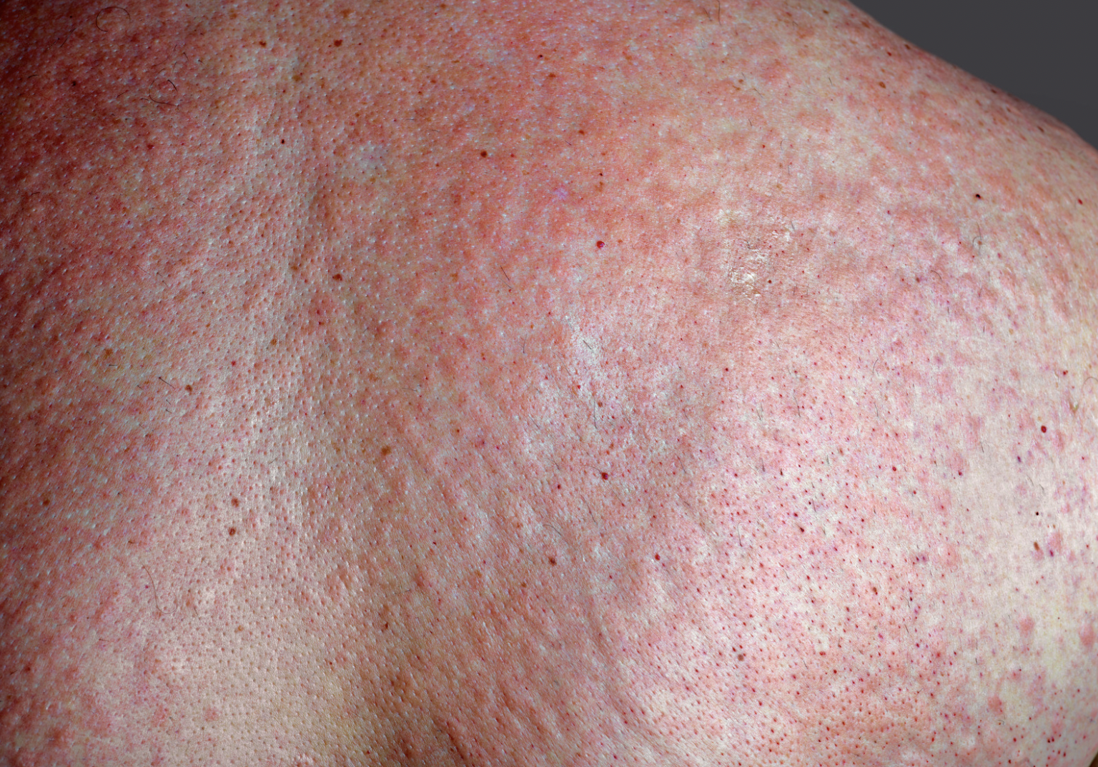 dermatology-surgery-associates-dsa-bronx-ny-intertrigo-1