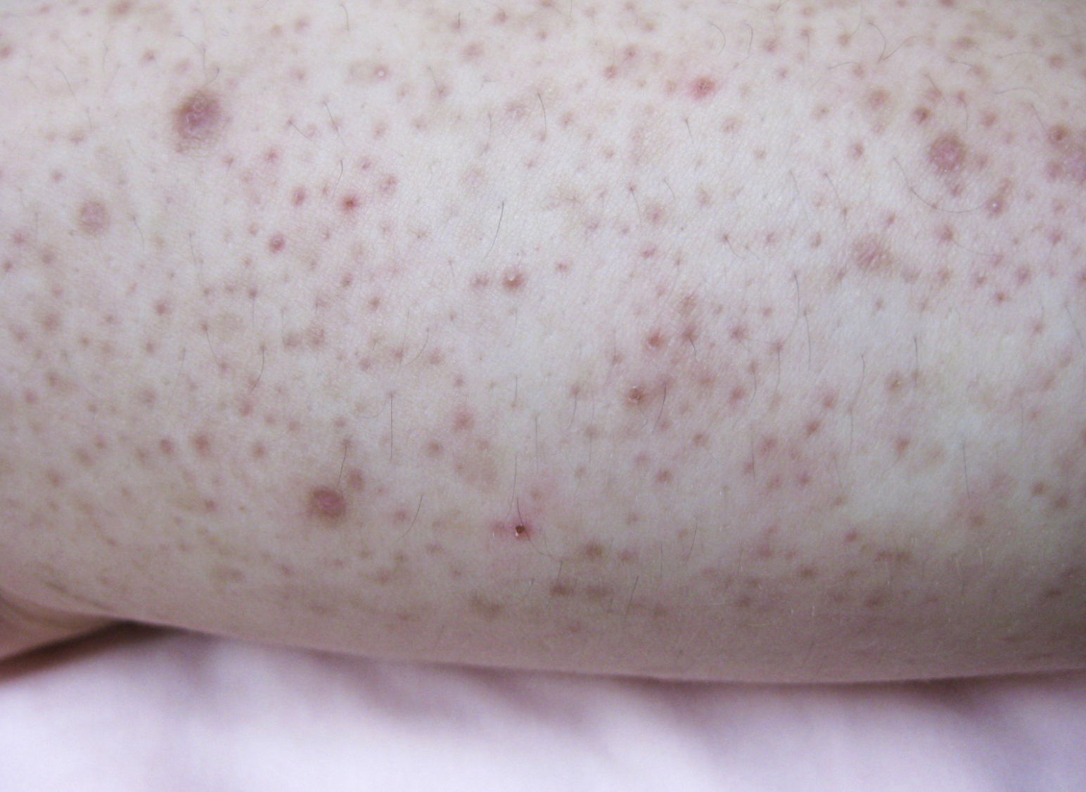 dermatology-surgery-associates-dsa-bronx-ny-keratosis-pilaris-1