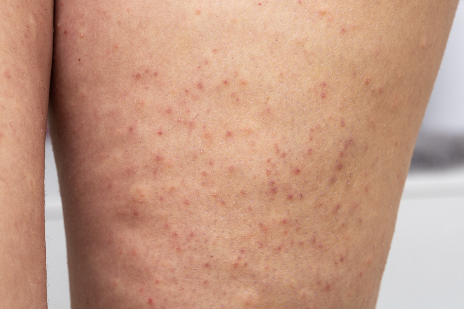 dermatology-surgery-associates-dsa-bronx-ny-keratosis-pilaris