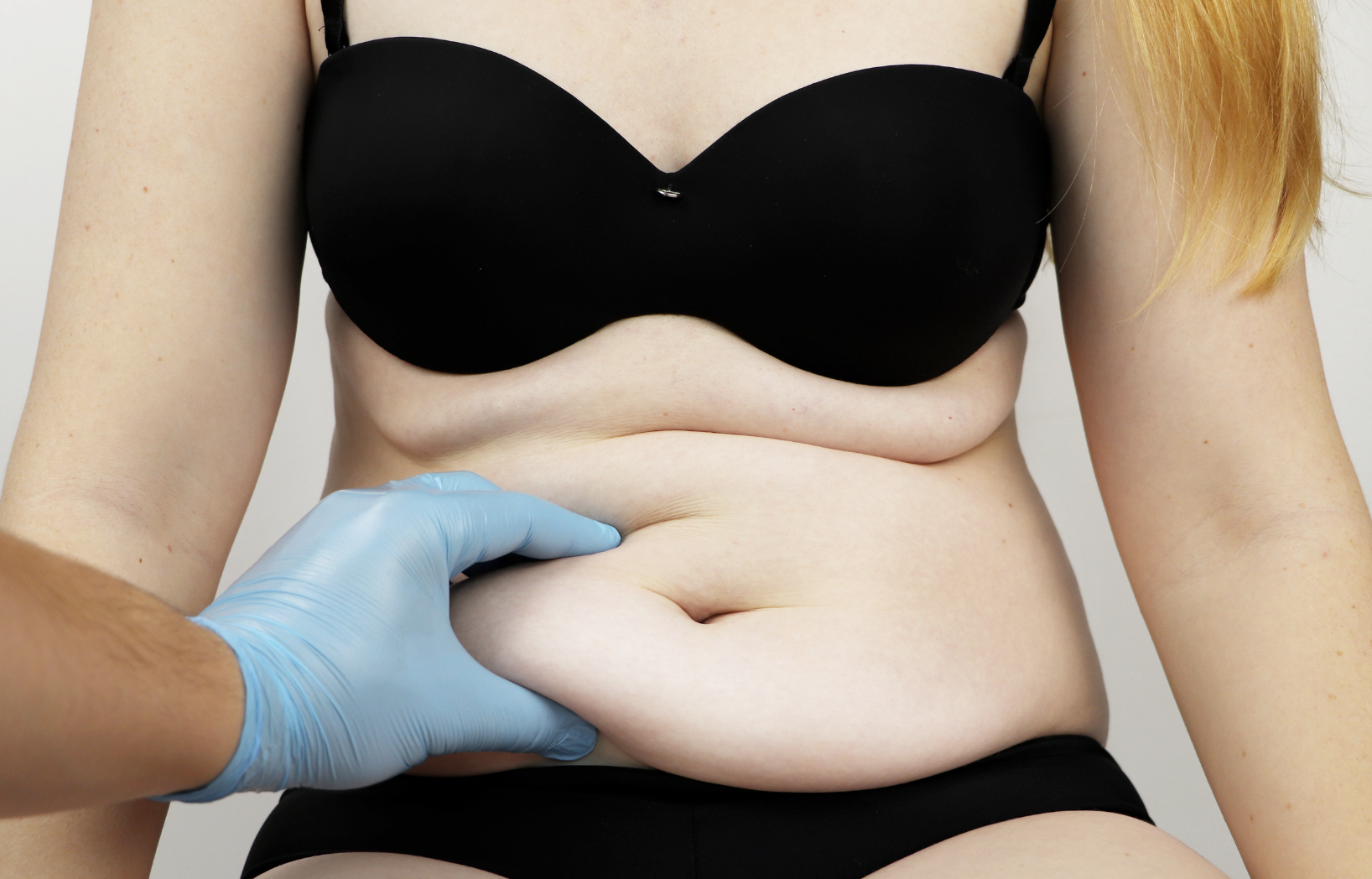dermatology-surgery-associates-dsa-bronx-ny-liposuction