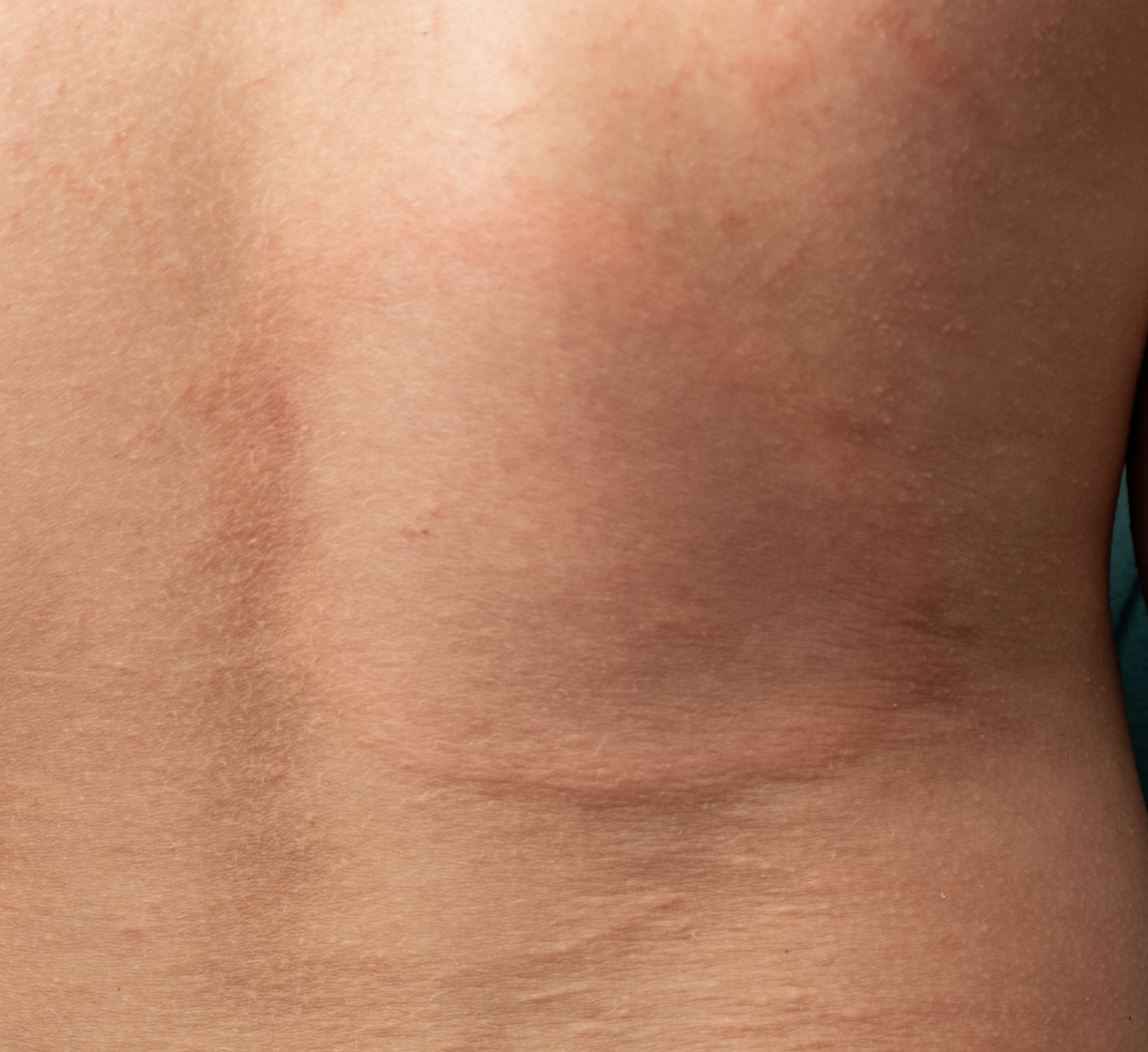dermatology-surgery-associates-dsa-bronx-ny-lyme-disease-1