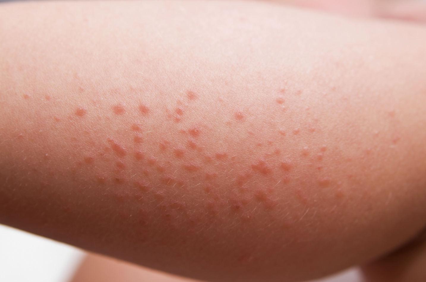 dermatology-surgery-associates-dsa-bronx-ny-poison-ivy-oak-sumac-1