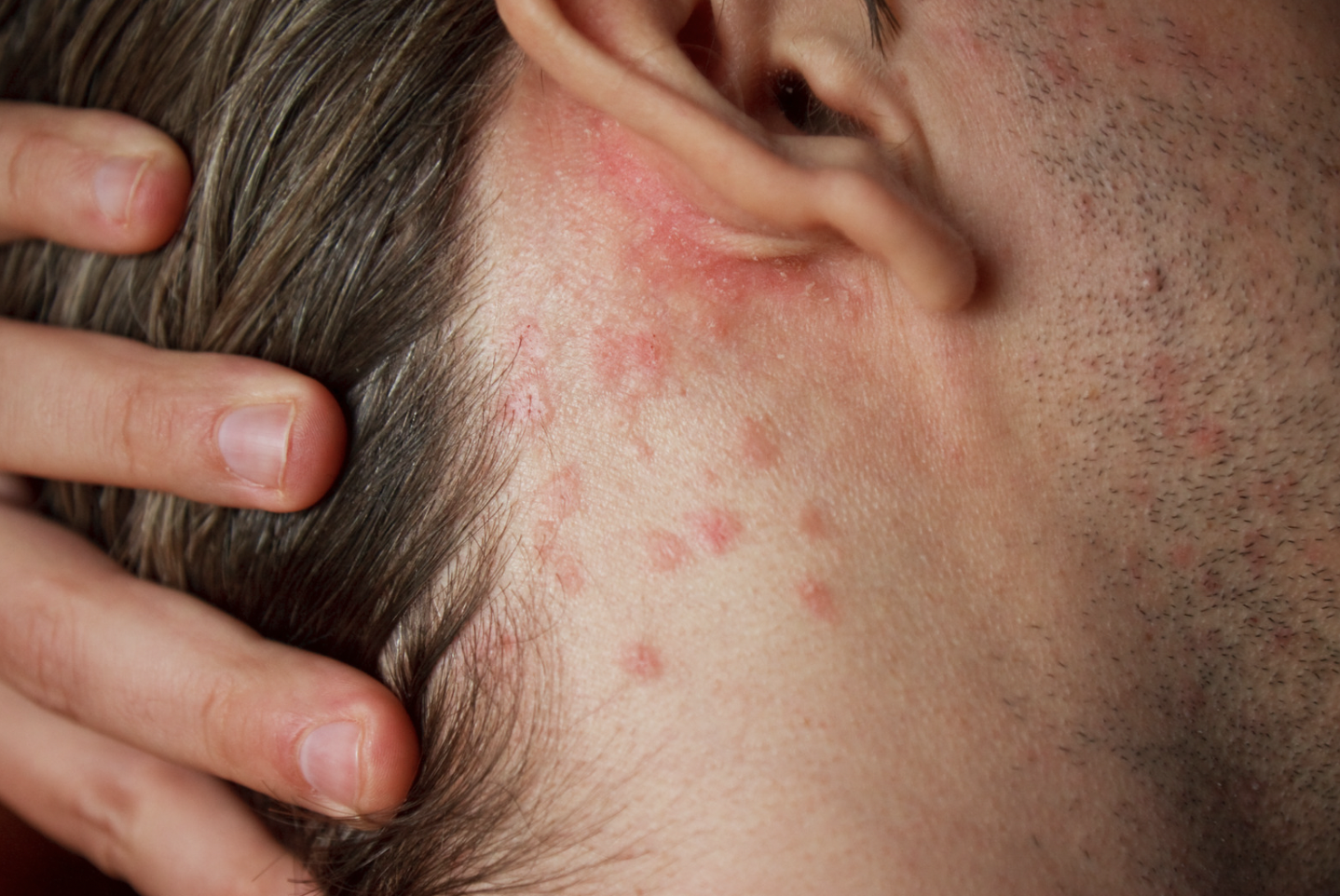 dermatology-surgery-associates-dsa-bronx-ny-poison-ivy-oak-sumac