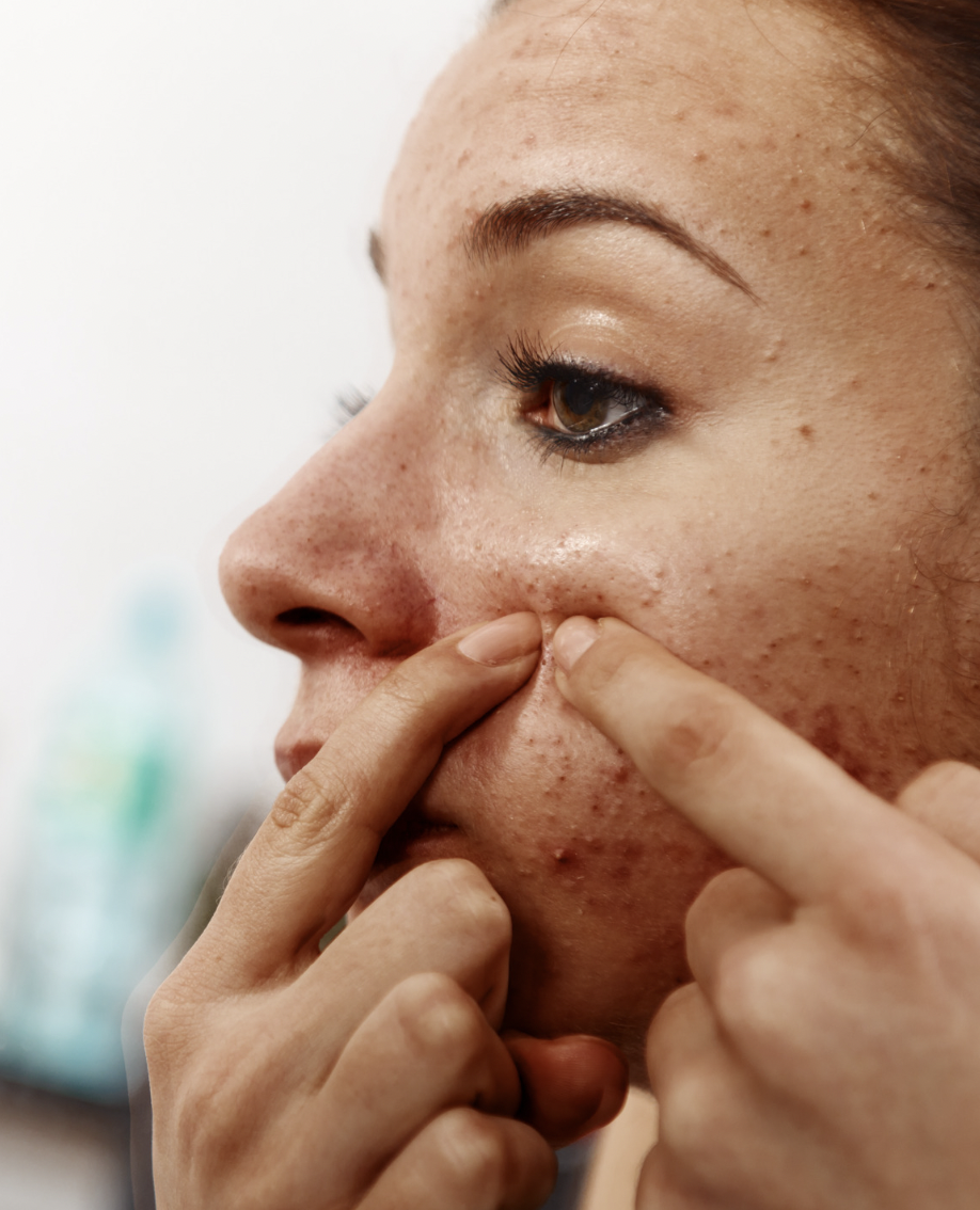 dermatology-surgery-associates-dsa-bronx-ny-pregnancy-related-skin-conditions-acne