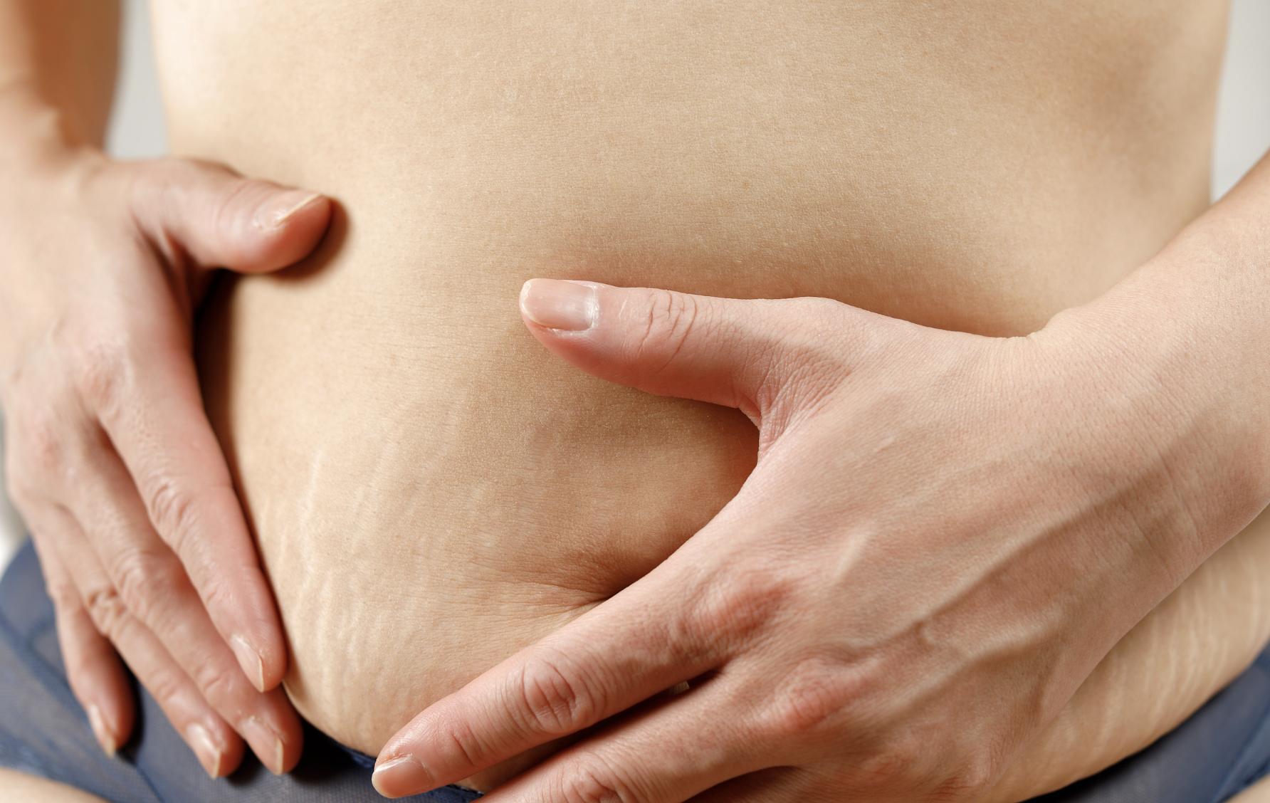 dermatology-surgery-associates-dsa-bronx-ny-pregnancy-related-skin-conditions-stretch-marks