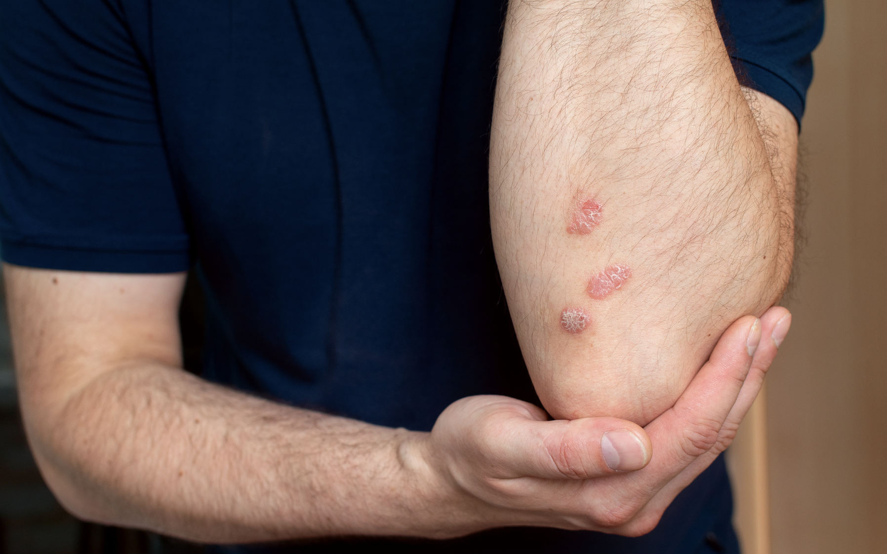 dermatology-surgery-associates-dsa-bronx-ny-psoriasis-2