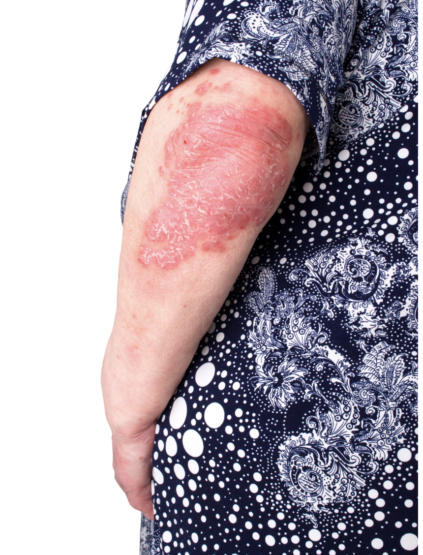 dermatology-surgery-associates-dsa-bronx-ny-psoriasis