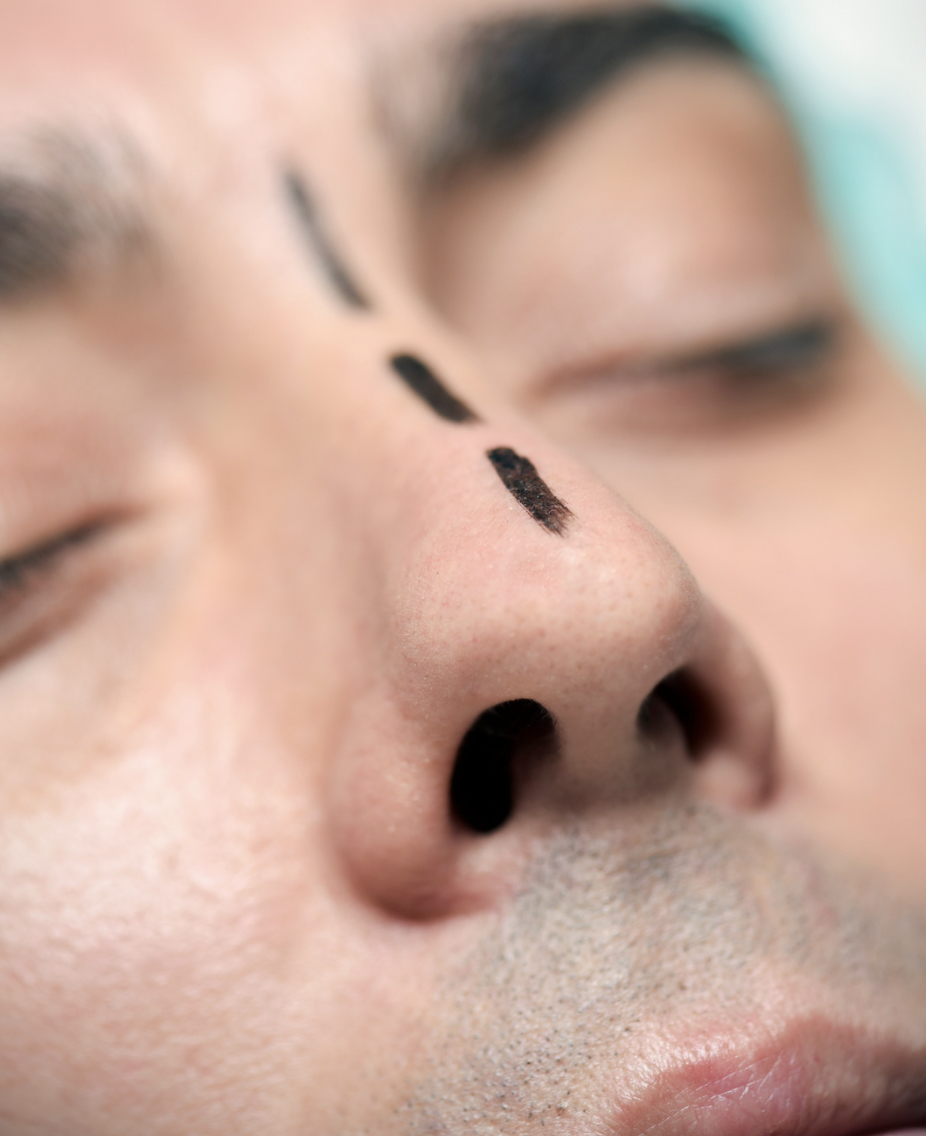 dermatology-surgery-associates-dsa-bronx-ny-rhinoplasty-1