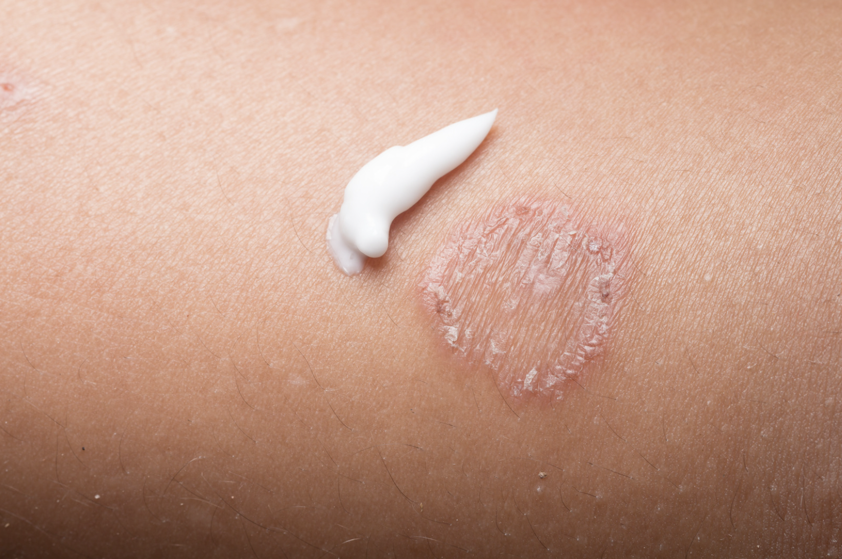 dermatology-surgery-associates-dsa-bronx-ny-ringworm-1
