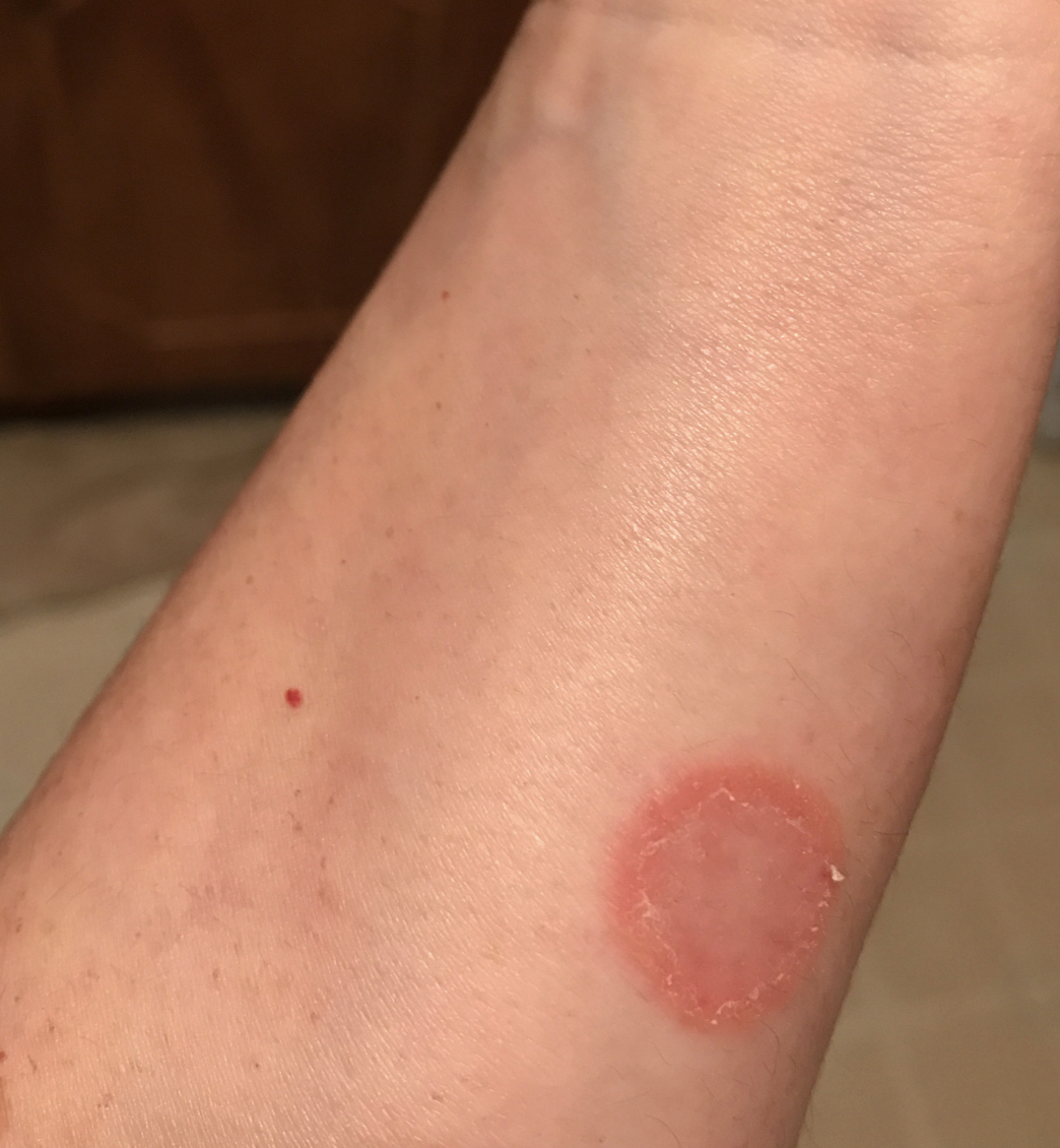 dermatology-surgery-associates-dsa-bronx-ny-ringworm
