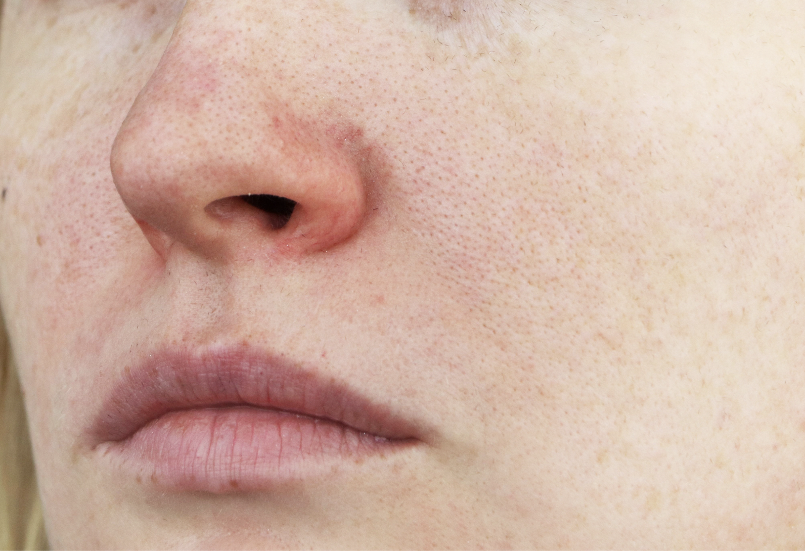 dermatology-surgery-associates-dsa-bronx-ny-rosacea-1