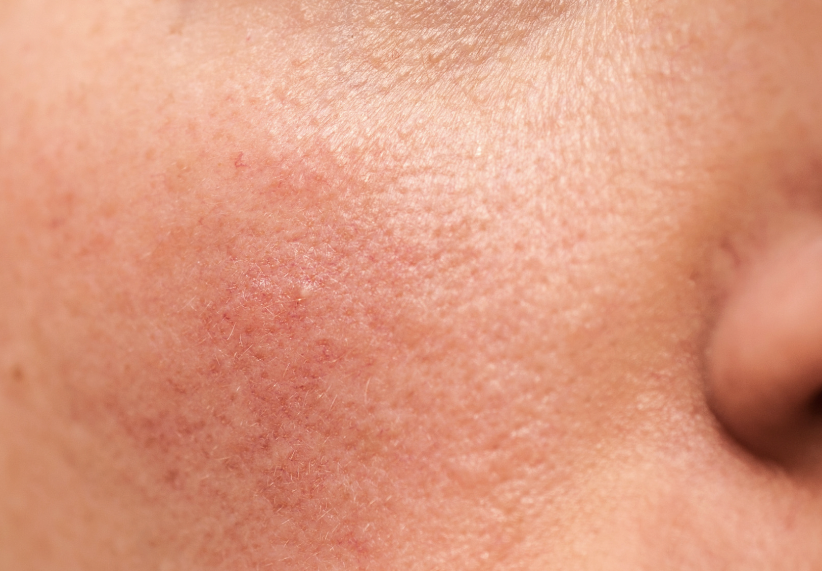 dermatology-surgery-associates-dsa-bronx-ny-rosacea