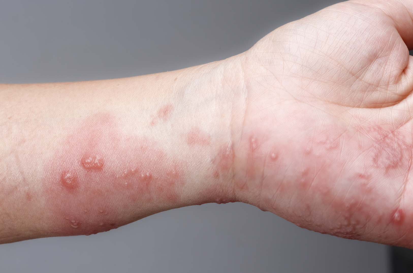 dermatology-surgery-associates-dsa-bronx-ny-scabies
