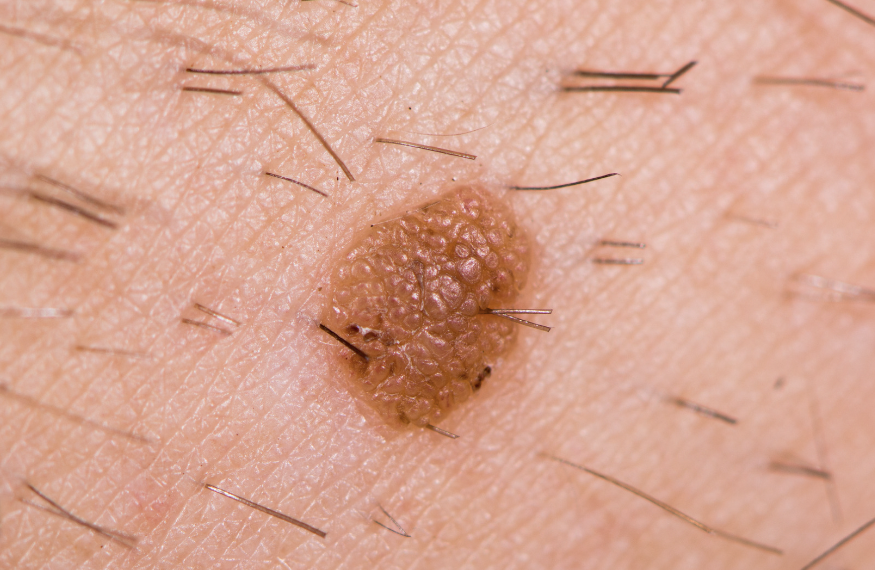 dermatology-surgery-associates-dsa-bronx-ny-seborrheic-keratoses-1