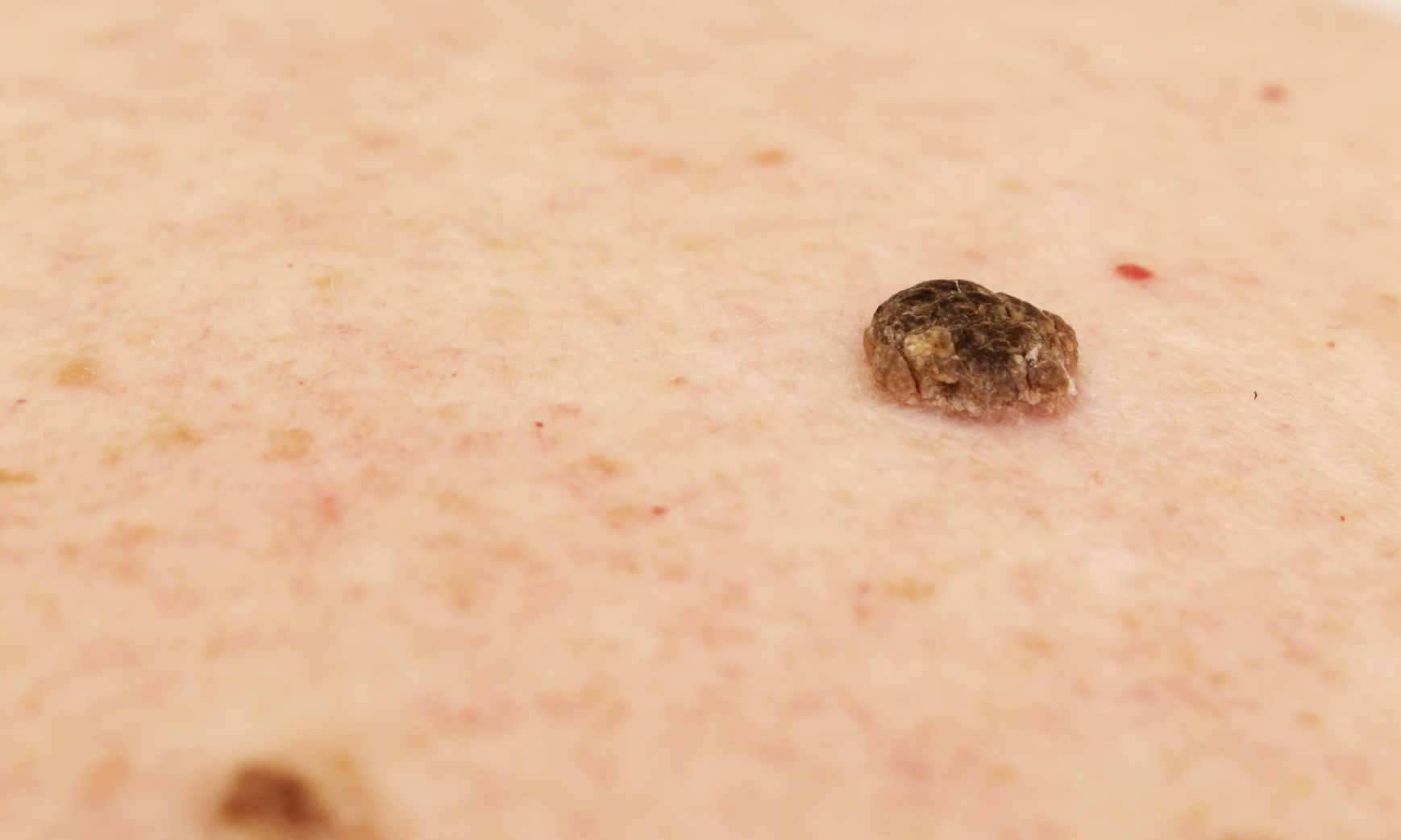 dermatology-surgery-associates-dsa-bronx-ny-seborrheic-keratoses