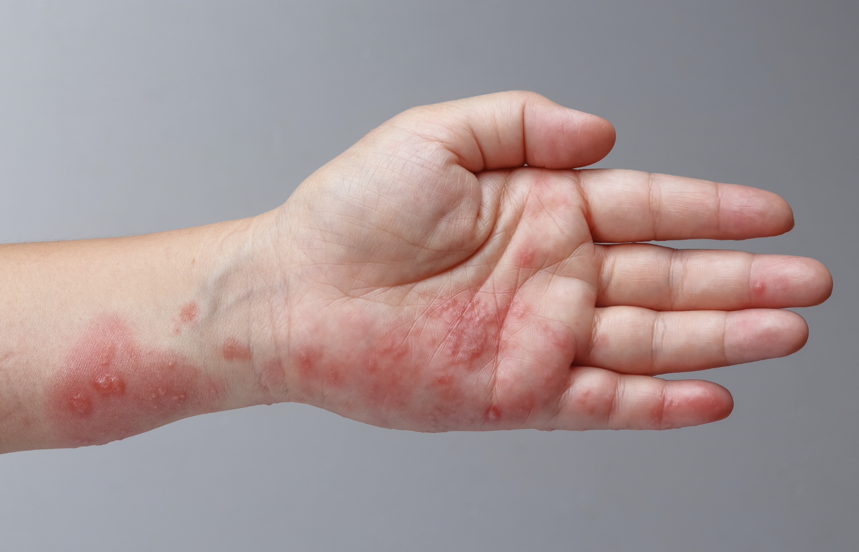 dermatology-surgery-associates-dsa-bronx-ny-shingles-herpes-zoster-1