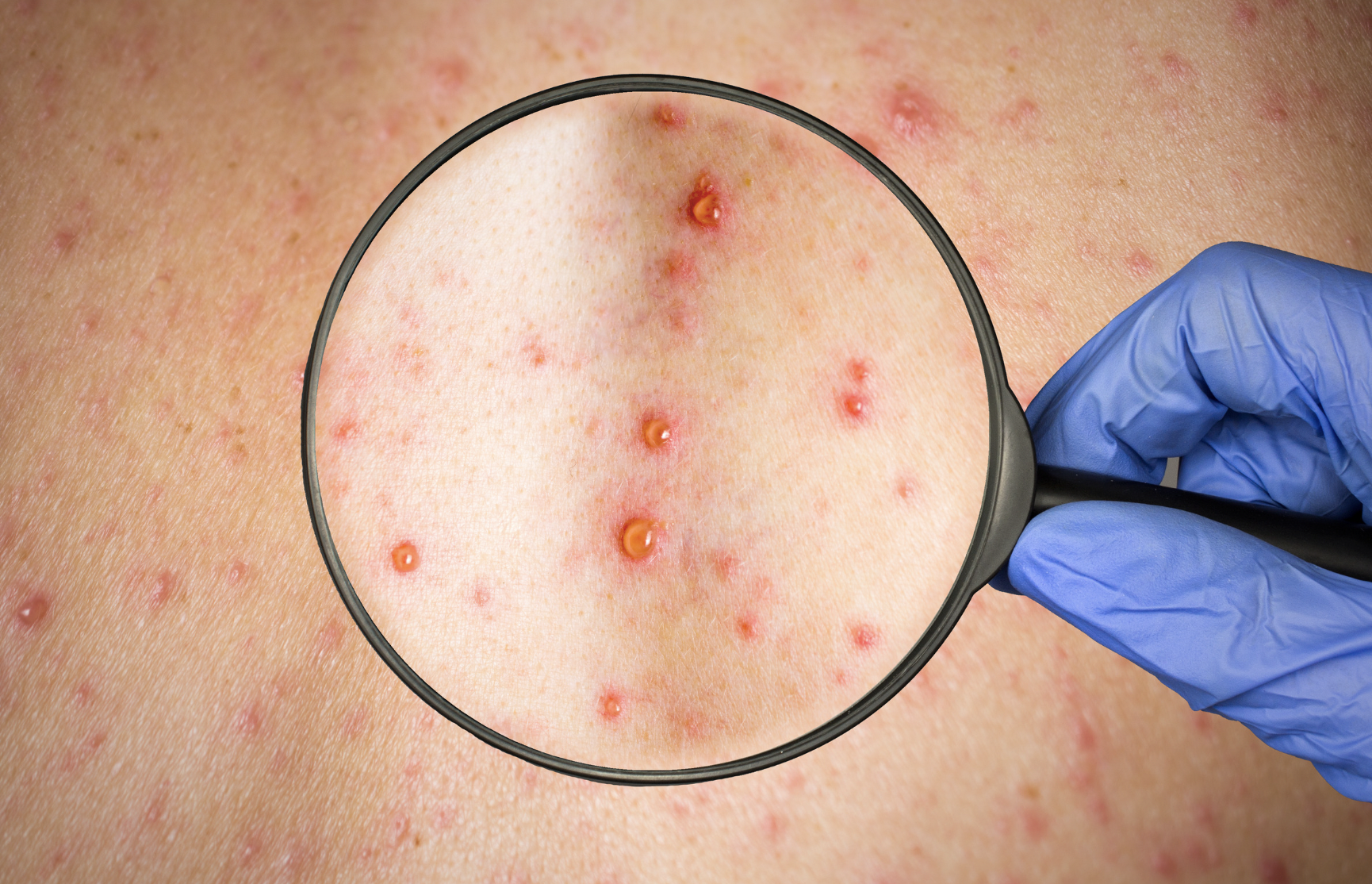 dermatology-surgery-associates-dsa-bronx-ny-shingles-herpes-zoster