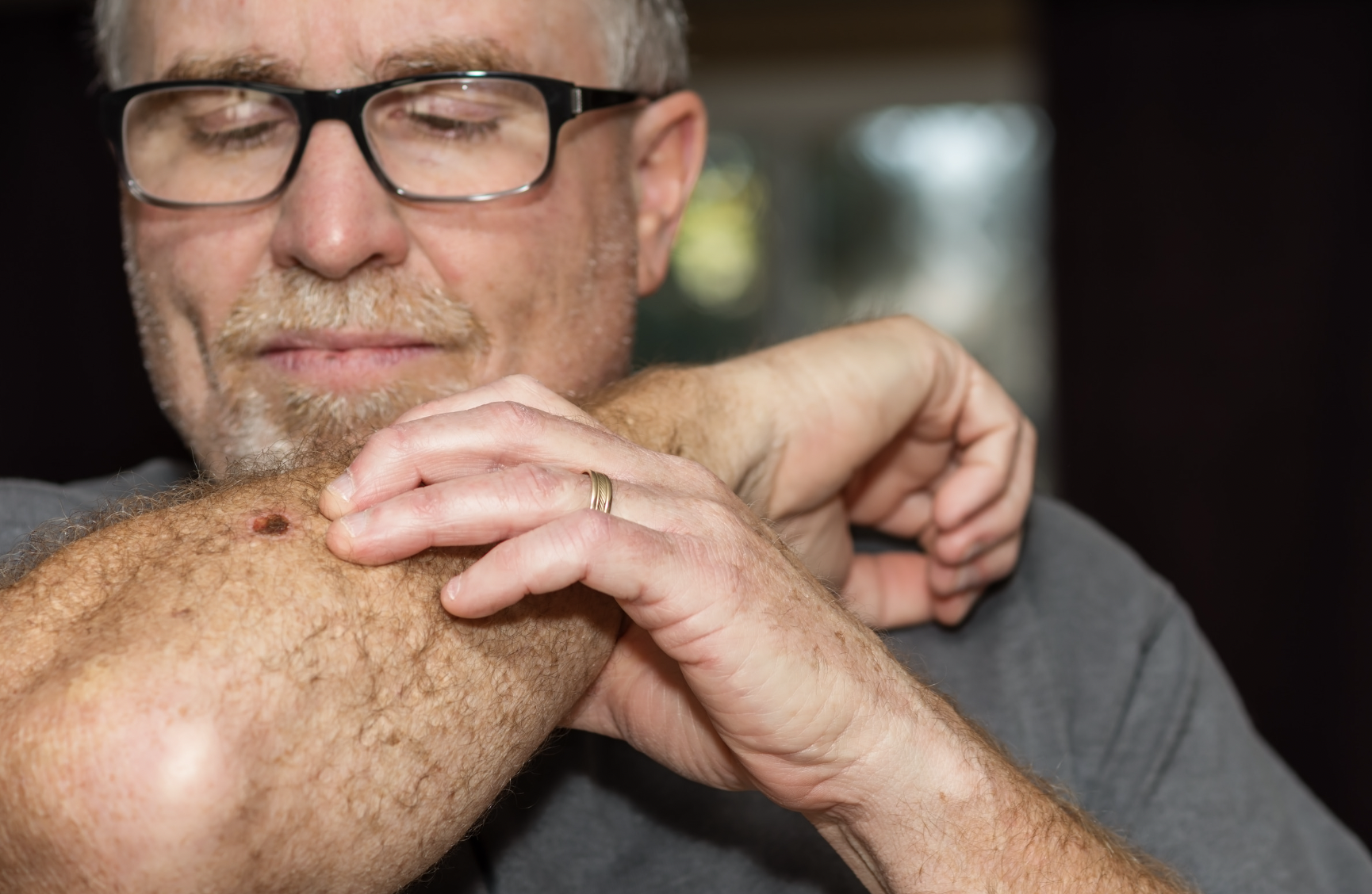 dermatology-surgery-associates-dsa-bronx-ny-skin-cancer dermatology surgery associates patient with potential skin cancer on arm bronx ny