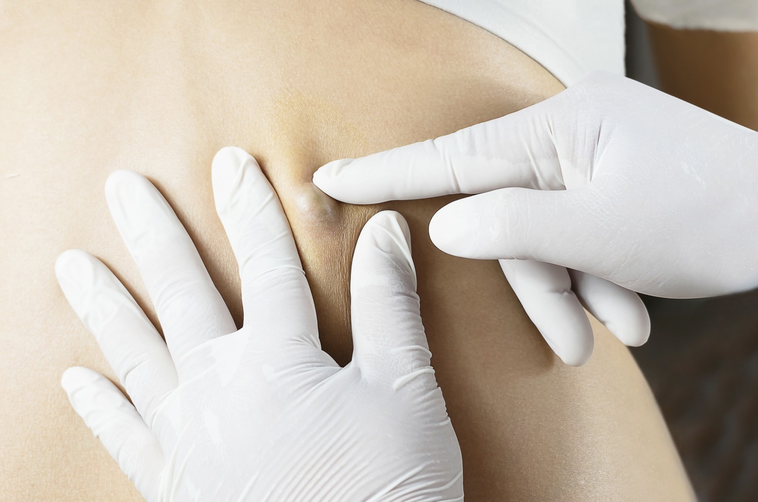 dermatology-surgery-associates-dsa-bronx-ny-skin-lumps-bumps-cysts-1