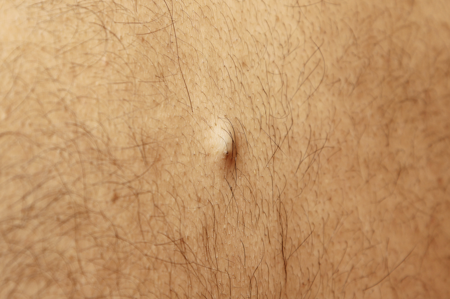 dermatology-surgery-associates-dsa-bronx-ny-skin-lumps-bumps-cysts