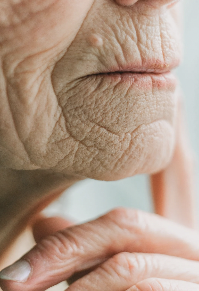 dermatology-surgery-associates-dsa-bronx-ny-wrinkles