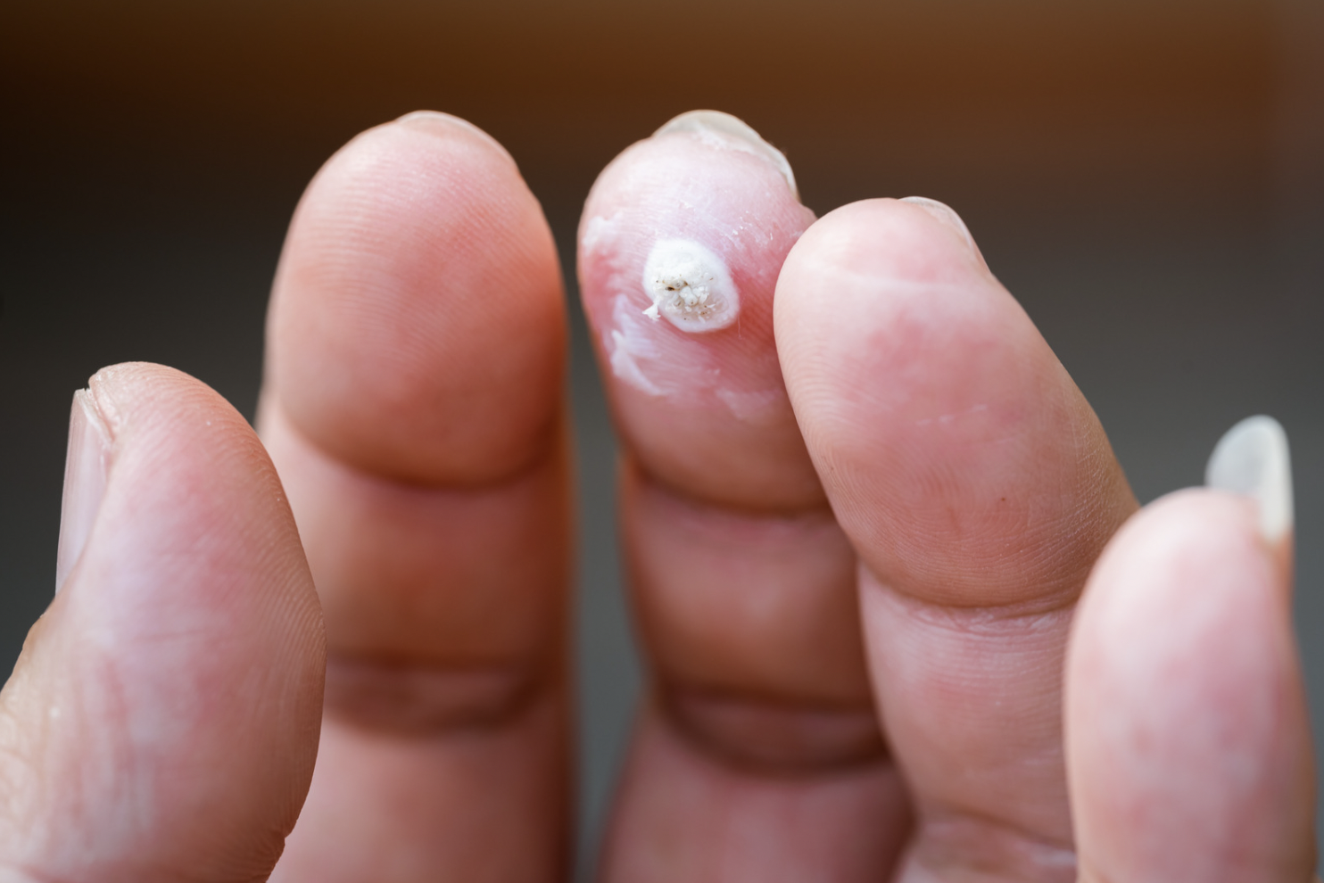 dermatology-surgery-associates-dsa-bronxy-ny-warts