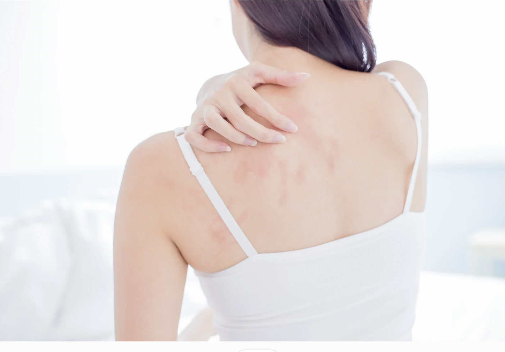 dermatology-surgery-associates-dsa-eczema-dermatitis-1