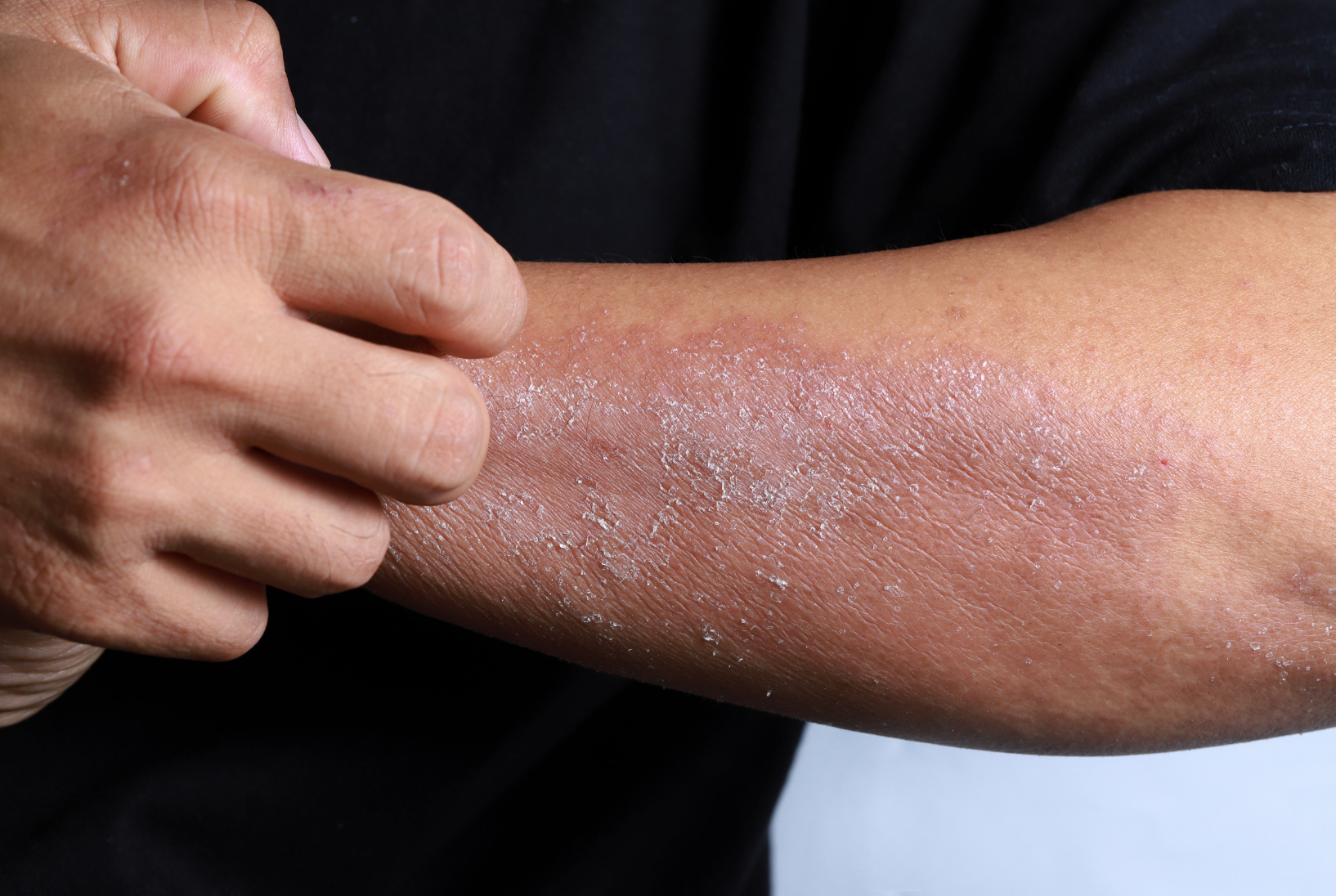 dermatology-surgery-associates-dsa-eczema-dermatitis