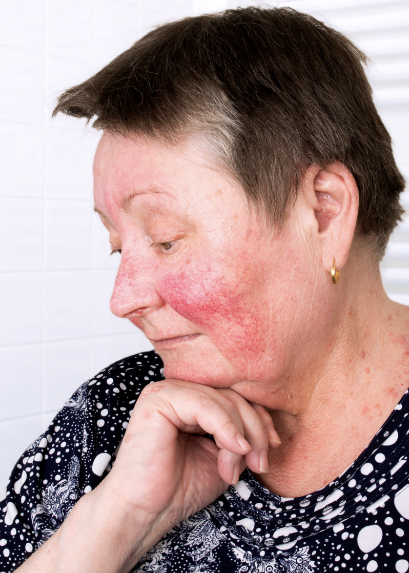 dermatology-surgery-associates-dsa-erysipelas-1
