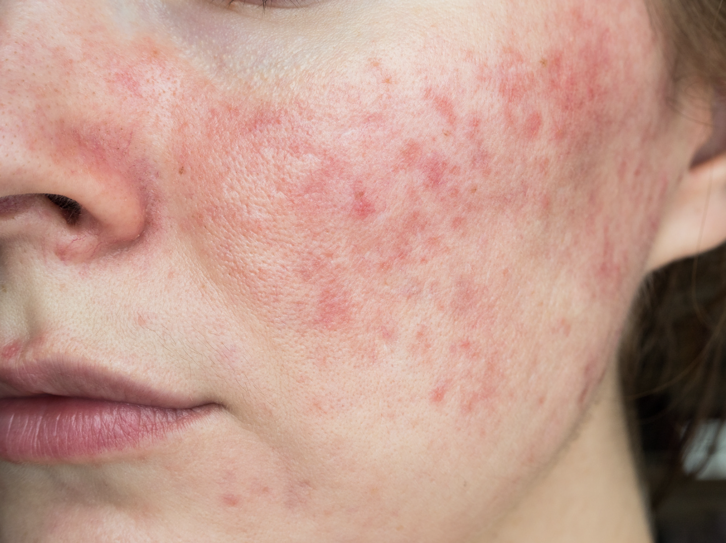 dermatology-surgery-associates-dsa-erysipelas