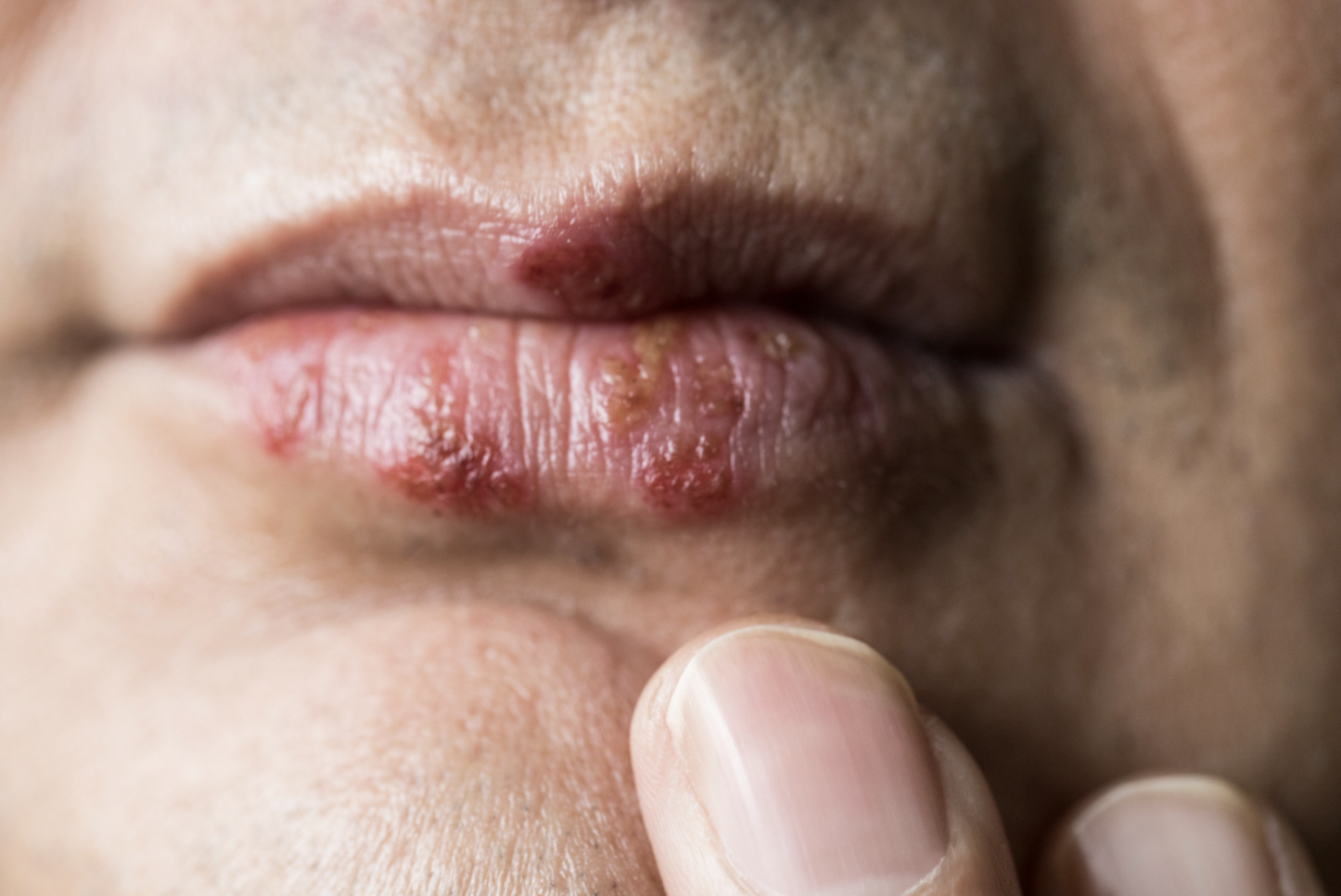 dermatology-surgery-associates-dsa-herpes-simplex-1