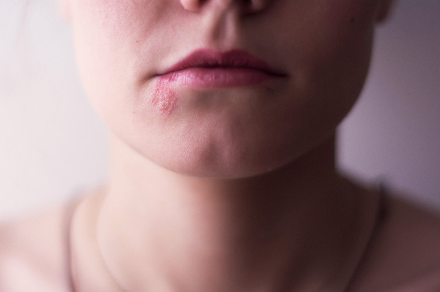 dermatology-surgery-associates-dsa-herpes-simplex