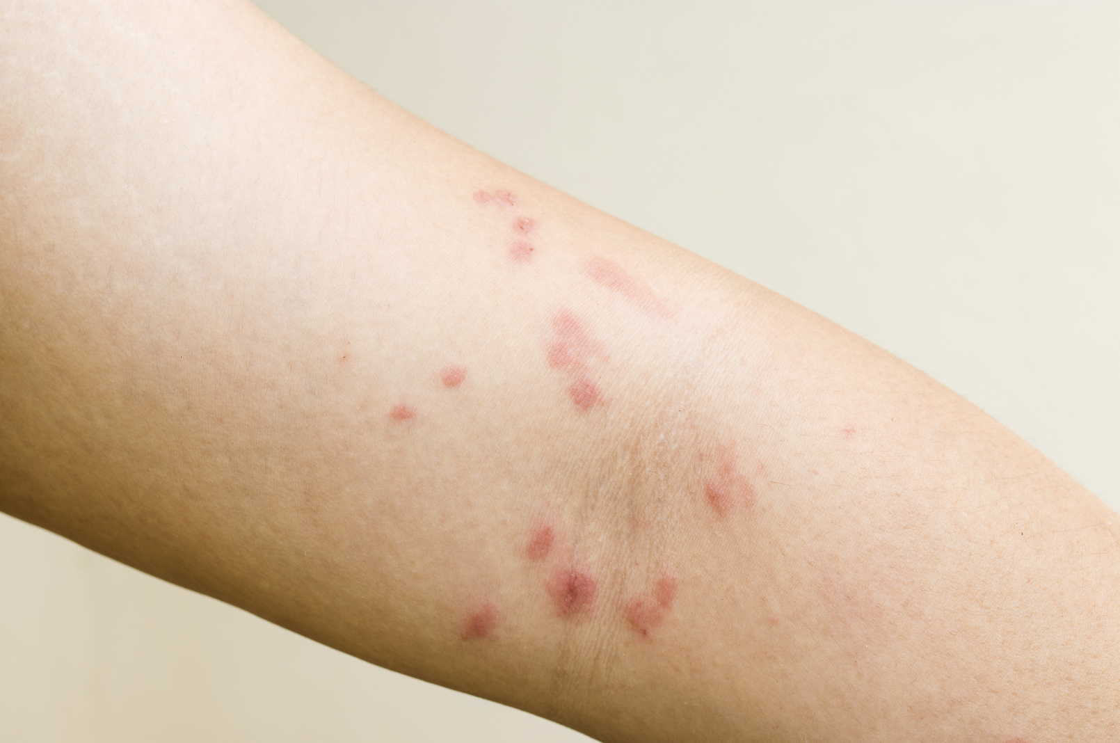 dermatology-surgery-associates-dsa-skin-rash-1