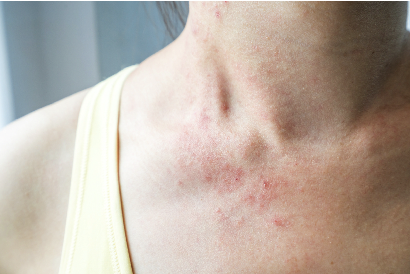 dermatology-surgery-associates-dsa-skin-rash
